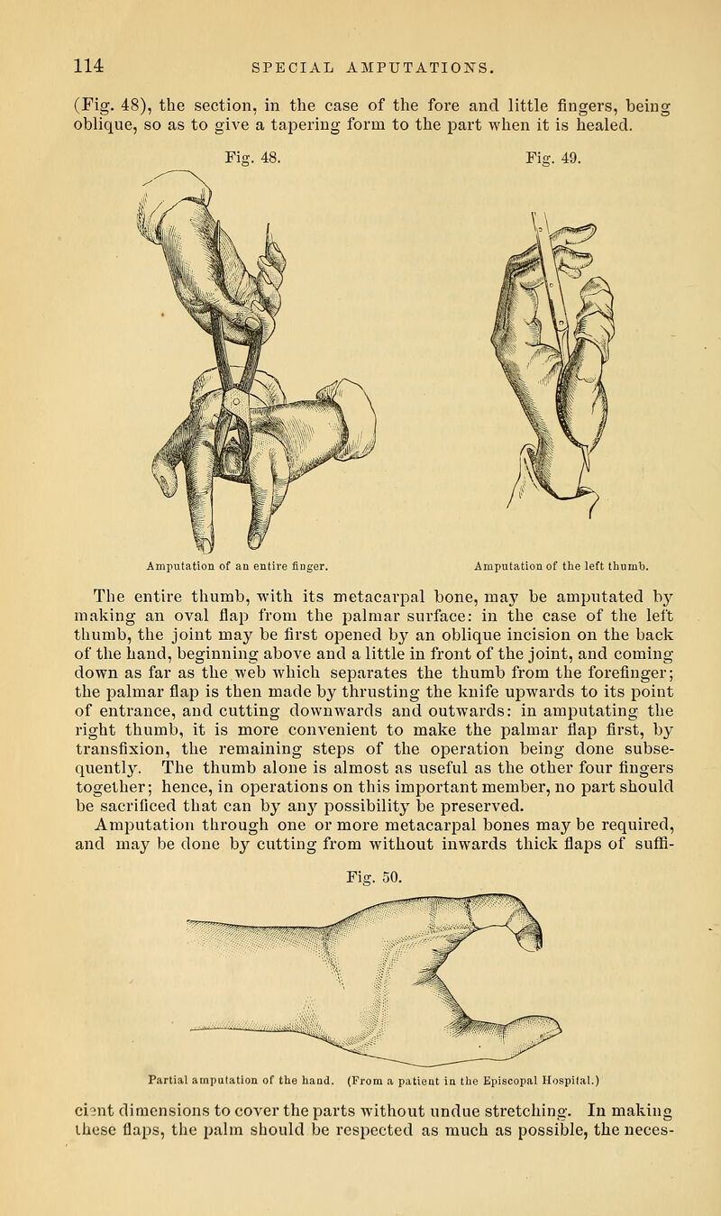 (Fig. 48), the section, in the case of the fore and little fingers, being oblique, so as to give a tapering form to the part when it is healed. Fie;. 48. Fii?. 49. Amputation of an entire finger. Amputation of the left thumti. The entire thumb, with its metacarpal bone, may be amputated by making an oval flap from the palmar surface: in the case of the left thumb, the joint may be first opened by an oblique incision on the back of the hand, beginning above and a little in front of the joint, and coming- down as far as the web which separates the thumb from the forefinger; the palmar flap is then made by thrusting the knife upwards to its point of entrance, and cutting downwards and outwards: in amputating the right thumb, it is more convenient to make the palmar flap first, by transfixion, the remaining steps of the operation being done subse- quently. The thumb alone is almost as useful as the other four fingers together; hence, in operations on this important member, no part should be sacrificed that can by any possibility be preserved. Amputation through one or more metacarpal bones may be required, and may be done by cutting from without inwards thick flaps of suflS- Fiff. 50. Partial atnpulation of the haad. (From a patieat in the Episcopal Hospital.) ciMit dimensions to cover the parts without undue stretching. In making Uicse flaps, the palm should be respected as much as possible, the neces-