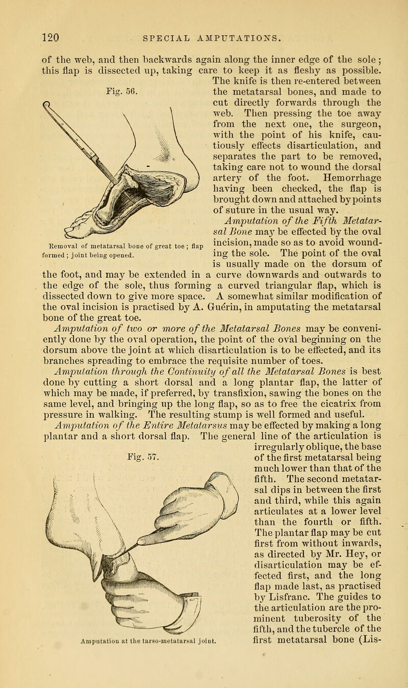 Fia;. 56. Eemoval of metatarsal bone of great toe ; formed ; joint being opened. flap of the web, and then backwards again along the inner edge of the sole ; this flap is dissected iip, taking care to keep it as fleshy as possible. The knife is then re-entered between the metatarsal bones, and made to cut directly forwards through the web. Then pressing the toe away from the next one, the surgeon, with the point of his knife, cau- tiously effects disarticulation, and separates the part to be removed, taking care not to wound the dorsal artery of the foot. Hemorrhage having been checked, the flap is brought down and attached by points of suture in the usual way. Amputation of the Fifth Metatar- sal Bone maj^be effected by the oval incision, made so as to avoid wound- ing the sole. The point of the oval is usually made on the dorsum of the foot, and may be extended in a curve downwards and outwards to the edge of the sole, thus forming a curved triangular flap, which is dissected down to give more space. A somewhat similar modification of the oval incision is practised by A. Guerin, in amputating the metatarsal bone of the great toe. Amputation of two or more of the Metatarsal Bones may be conveni- ently done by the oval operation, the point of the oval beginning on the dorsum above the joint at which disarticulation is to be effected, and its branches spreading to embrace the requisite number of toes. Amputation through the Continuity of all the Metatarsal Bones is best done by cutting a short dorsal and a long plantar flap, the latter of which may be made, if preferred, by transfixion, sawing the bones on the same level, and bringing up the long flap, so as to free the cicatrix from pressure in walking. The resulting stump is well formed and useful. Amputation of the Entire Metatarsus may be effected by making a long plantar and a short dorsal flap. The general line of the articulation is irregularly oblique, the base Fig. 57. of the first metatarsal being much lower than that of the fifth. The second metatar- sal dips in between the first and third, while this again articulates at a lower level than the fourth or fifth. The plantar fiap may be cut first from without inwards, as directed by Mr. Hey, or disarticulation may be ef- fected first, and the long flap made last, as practised hy Lisfranc. The guides to the articulation are the pro- minent tuberosity of the fifth, and the tubercle of the Amputation at the tarso-metatarsal joint. first metatarsal bonC (Lis-