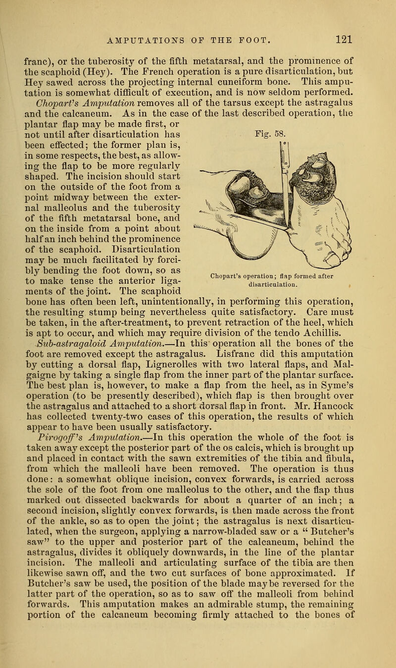franc), or the tuberosity of the fifth metatarsal, and the prominence of the scaphoid (Hey). The French operation is a pure disarticulation, but Hey sawed across the projecting internal cuneiform bone. This ampu- tation is somewhat difficult of execution, and is now seldom performed. CJioparVs Amputation removes all of the tarsus except the astragalus and the calcaneum. As in the case of the last described operation, the plantar flap may be made first, or not until after disarticulation has Fig. 58. been effected; the former plan is, in some respects, the best, as allow- ing the flap to be more regularly shaped. The incision should start on the outside of the foot from a point midway between the exter- nal malleolus and the tuberosity of the fifth metatarsal bone, and on the inside from a point about half an inch behind the prominence of the scaphoid. Disarticulation may be much facilitated by forci- bly bending the foot down, so as to make tense the anterior hga- disarticulation. ments of the joint. The scaphoid bone has often been left, unintentionally, in performing this operation, the resulting stump being nevertheless quite satisfactory. Care must be taken, in the after-treatment, to prevent retraction of the heel, which is apt to occur, and which may require division of the tendo Achillis. Buh-astragaloid Amputation.—In this' operation all the bones of the foot are removed except the astragalus. Lisfranc did this amputation by cutting a dorsal flap, Lignerolles with two lateral flaps, and Mal- gaigne by taking a single flap from the inner part of the plantar surface. The best plan is, however, to make a flap from the heel, as in Syme's operation (to be presently described), which flap is then brought over the astragalus and attached to a short dorsal flap in front. Mr. Hancock has collected twenty-two cases of this operation, the results of which appear to have been usually satisfactory. Pirogojf^s Amputation.—In this operation the whole of the foot is taken away except the posterior part of the os calcis, which is brought up and placed in contact with the sawn extremities of the tibia and flbula, from which the malleoli have been removed. The operation is thus done: a somewhat oblique incision, convex forwards, is carried across the sole of the foot from one malleolus to the other, and the flap thus marked out dissected backwards for about a quarter of an inch; a second incision, slightly convex forwards, is then made across the front of the ankle, so as to open the joint; the astragalus is next disarticu- lated, when the surgeon, applying a narrow-bladed saw or a  Butcher's saw to the upper and posterior part of the calcaneum, behind the astragalus, divides it obliquely downwards, in the line of the plantar incision. The malleoli and articulating surface of the tibia are then likewise sawn off, and the two cut surfaces of bone approximated. If Butcher's saw be used, the position of the blade maj^be reversed for the latter part of the operation, so as to saw off the malleoli from behind forwards. This amputation makes an admirable stump, the remaining portion of the calcaneum becoming firmly attached to the bones of