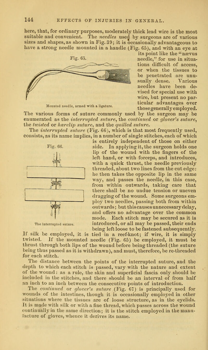 Moanted needle, armed with a ligature. Fiff. 66. here, that, for ordinary purposes, moderately thick lead wire is the most suitable and convenient. The needles used hy surgeons are of various sizes and shapes, as shown in Fig. 39; it is occasionally advantageous to have a strong needle mounted in a handle (Fig. 65), and with an eye at its point like the nsevus Fig. 65. needle, for use in situa- tions difficult of access, or when the tissues to be penetrated are unu- sually dense. Various needles have been de- vised for special use with wire, but present no par- ticular advantages over those generally employed. The various forms of suture commonly used b}'^ the surgeon may be enumerated as the interrupted siitiire, the continued or glover's suture, the tioisted or harelijj suture, and the quilled suture. The interrupted suture (Fig. 66), which is that most frequently used, consists, as its name implies, in a number of single stitches, each of which is entirely independent of those on either side. In applying it, the surgeon holds one lip of the wound with the fingers of the left hand, or with forceps, and introduces, with a quick thrust, the needle previously threaded, about two lines from the cut edge: he then takes the opposite lip in the same way, and passes the needle, in this case, from within outwards, taking care that there shall be no undue tension or uneven dragging of the wound. Some surgeons em- ploy two needles, passing both from within ^^ outwards; but this causes unnecessary delaj^, 11 i and offers no advantage over the common I mode. Each stitch may be secured as it is The interrupted suture. introduced, or all may be passed, their ends being left loose to be fastened subsequently. If silk be employed, it is tied in a reef-knot; if wire, it is simply twi.sted. If the mounted needle (Fig. 65) be employed, it must be thrust through both lips of the wound before being threaded (the suture being thus passed as it is withdi'awn), and must, therefore, be re-threaded for each stitch. The distance between the points of the interrupted suture, and the depth to which each stitch is passed, vary with the nature and extent of the wound: as a rule, the skin and superficial fascia only should be included in the stitches, and there should be an interval of from half an inch to an inch between the consecutive points of introduction. The continued or glover's suture (Fig. 67) is principally used for wounds of the intestines, though it is occasionally emploj'ed in other situations where the tissues are of loose structure, as in the eyelids. It is made with silk or with a fine thread, which passes across the wound continually in the same direction; it is the stitch employed in the manu- facture of gloves, whence it derives its name.