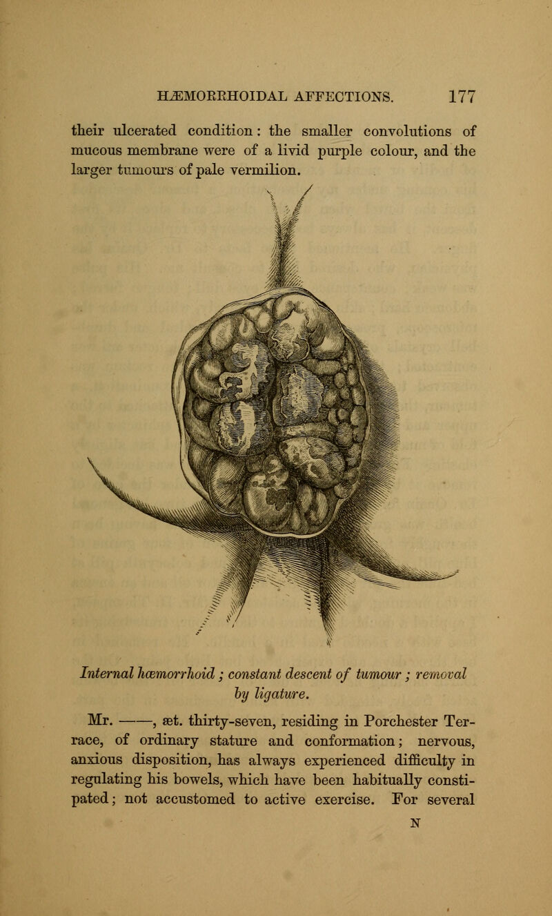 their ulcerated condition: the smaller convolutions of mucous membrane were of a livid purple colour, and the larger tumours of pale vermilion. Internal hcemorrhoid ; constant descent of tumour ; removal by ligature. Mr. , set. thirty-seven, residing in Porchester Ter- race, of ordinary stature and conformation; nervous, anxious disposition, has always experienced difficulty in regulating his bowels, which have been habitually consti- not accustomed to active exercise. For several