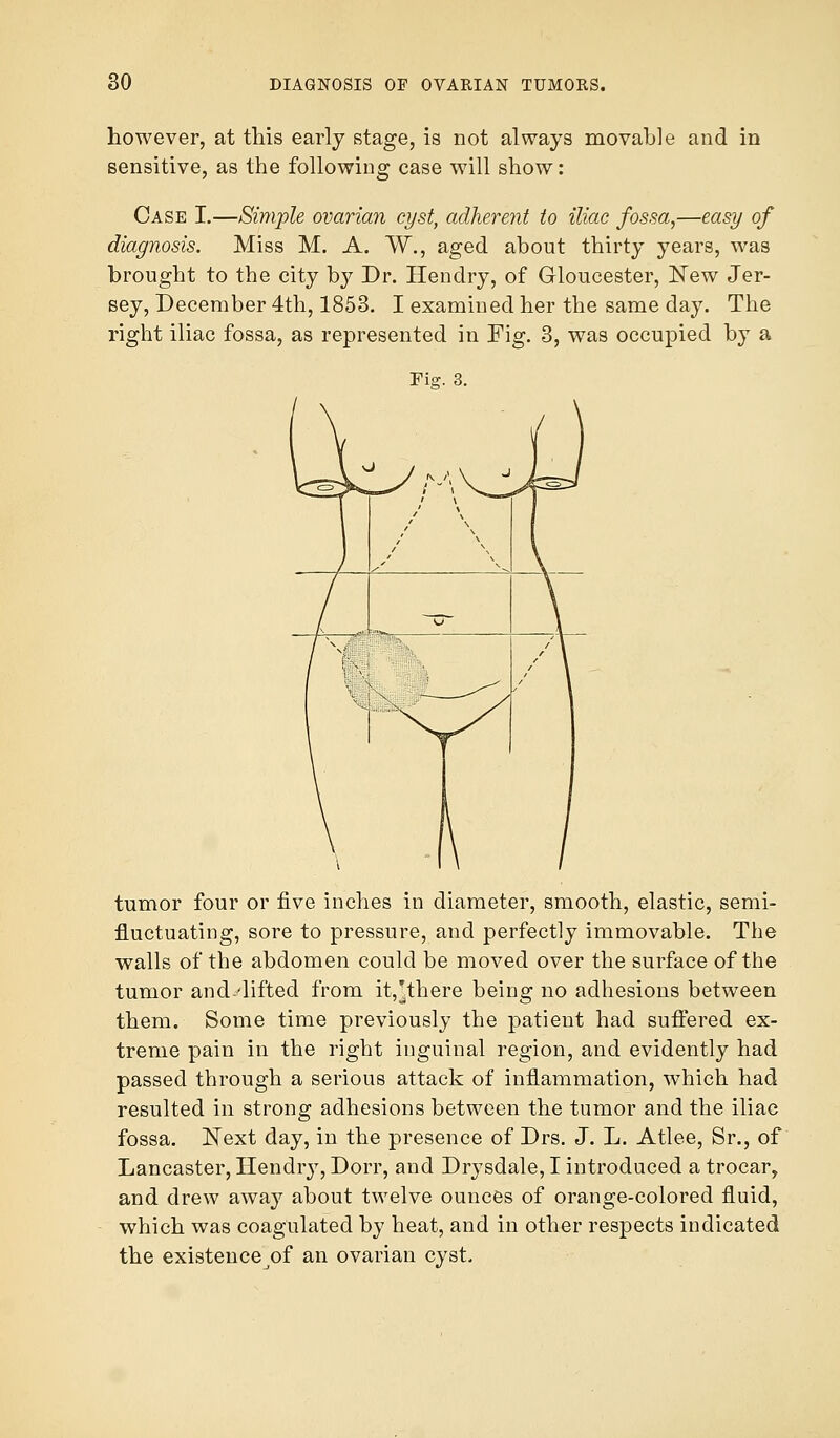 however, at this early stage, is not always movable and in sensitive, as the following case will show: Case I.—Simple ovarian cyst, adherent to iliac fossa,—easy of diagnosis. Miss M. A. W., aged about thirty years, was brought to the city by Dr. Hendry, of Gloucester, New Jer- sey, December 4th, 1853. I examined her the same clay. The right iliac fossa, as represented in Fig. 3, was occupied by a Fig. 3. tumor four or five inches in diameter, smooth, elastic, semi- fluctuating, sore to pressure, and perfectly immovable. The walls of the abdomen could be moved over the surface of the tumor and.'lifted from it,'there being no adhesions between them. Some time previously the patient had suffered ex- treme pain in the right inguinal region, and evidently had passed through a serious attack of inflammation, which had resulted in strong adhesions between the tumor and the iliac fossa. Next day, in the presence of Drs. J. L. Atlee, Sr., of Lancaster, Hendry, Dorr, and Drysdale, I introduced a trocar, and drew away about twelve ounces of orange-colored fluid, which was coagulated by heat, and in other respects indicated the existence^f an ovarian cyst.