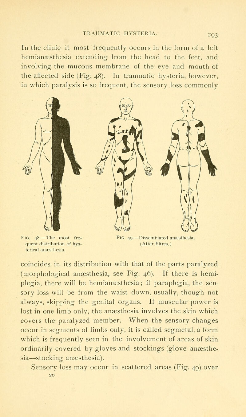 In the clinic it most frequently occurs in the form of a left hemianassthesia extending from the head to the feet, and involving the mucous membrane of the eye and mouth of the affected side (Fig. 48). In traumatic hysteria, however, in which paralysis is so frequent, the sensory loss commonly Fig. 48.—The most fre- quent distribution of hys- terical an£esthesia. Fig. 49.—Disseminated anesthesia. (After Pitres.) coincides in its distribution with that of the parts paralyzed (morphological ansesthesia, see Fig. 46). If there is hemi- plegia, there will be hemiancesthesia; if paraplegia, the sen- sory loss will be from the waist down, usually, though not always, skipping the genital organs. If muscular power is lost in one limb only, the anaesthesia involves the skin which covers the paralyzed member. When the sensory changes occur in segments of limbs only, it is called segmetal, a form which is frequently seen in the involvement of areas of skin ordinarily covered by gloves and stockings (glove an2esthe- sia—stocking anaesthesia). Sensory loss may occur in scattered areas (Fig. 49) over