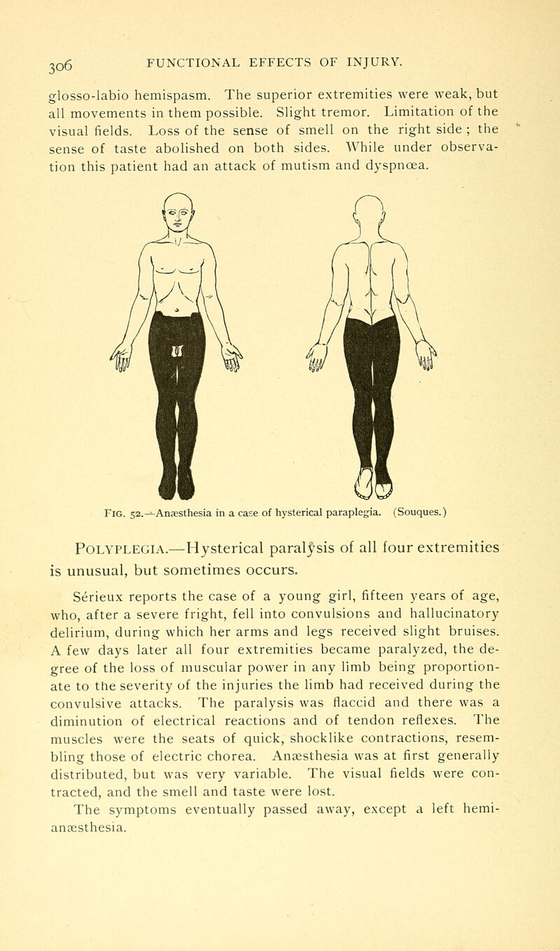glosso-labio hemispasm. The superior extremities were weak, but all movements in them possible. Slight tremor. Limitation of the visual fields. Loss of the sense of smell on the right side ; the sense of taste abolished on both sides. While under observa- tion this patient had an attack of mutism and dyspnoea. Fig. 52.—Anesthesia in a case of hysterical paraplegia. (Souques.) Polyplegia.—Hysterical paral_^sis of all four extremities is unusual, but sometimes occurs. Serieux reports the case of a young girl, fifteen years of age, who, after a severe fright, fell into convulsions and hallucinatory delirium, during which her arms and legs received slight bruises. A few days later all four extremities became paralyzed, the de- gree of the loss of muscular power in any limb being proportion- ate to the severity of the injuries the limb had received during the convulsive attacks. The paralysis was flaccid and there was a diminution of electrical reactions and of tendon reflexes. The muscles were the seats of quick, shocklike contractions, resem- bling those of electric chorea. Anaesthesia was at first generally distributed, but was very variable. The visual fields were con- tracted, and the smell and taste were lost. The symptoms eventually passed away, except a left hemi- ansesthesia.