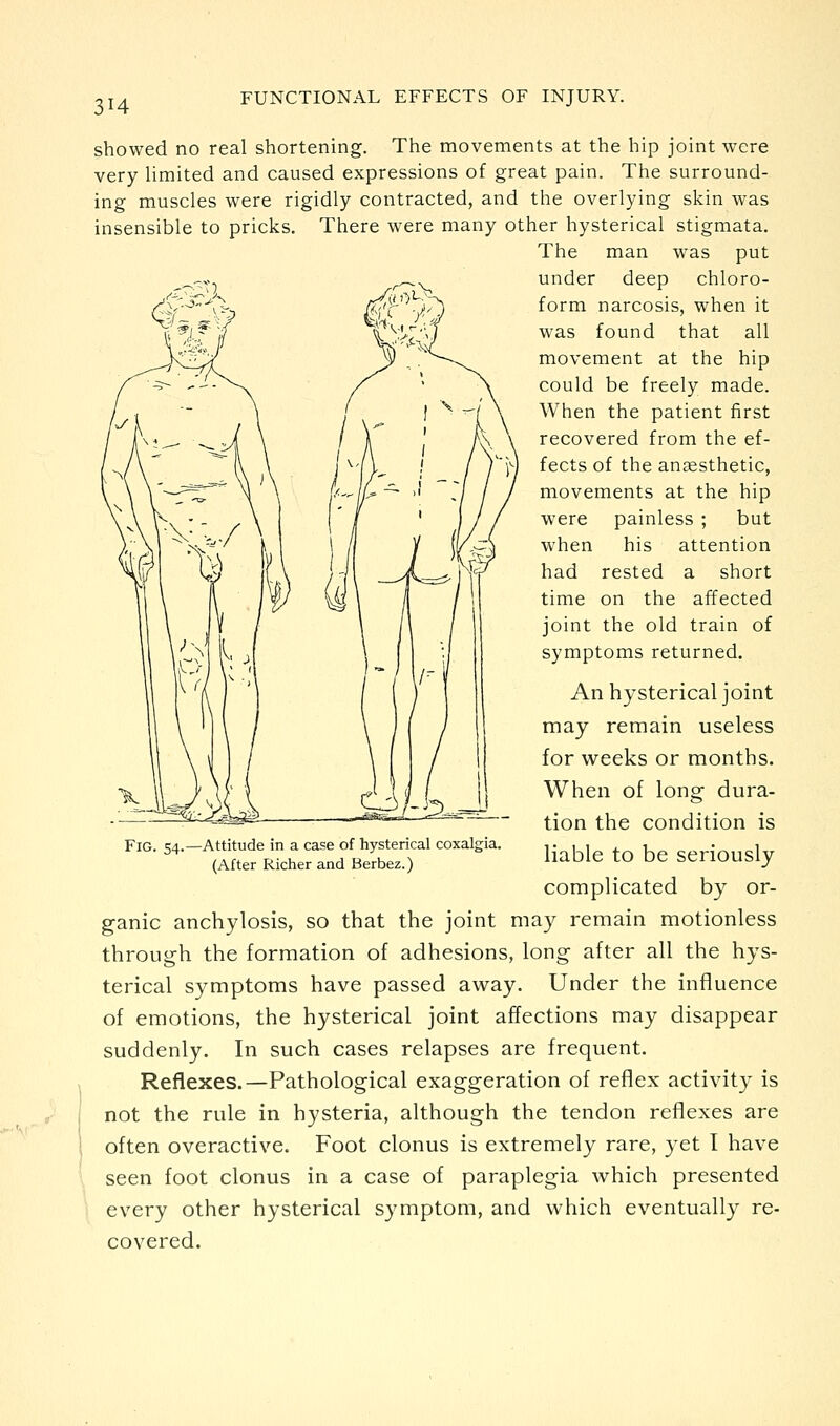 showed no real shortening. The movements at the hip joint were very Umited and caused expressions of great pain. The surround- ing muscles were rigidly contracted, and the overlying skin was insensible to pricks. There were many other hysterical stigmata. The man was put under deep chloro- form narcosis, when it was found that all movement at the hip could be freely made. When the patient first recovered from the ef- fects of the anaesthetic, movements at the hip were painless ; but when his attention had rested a short time on the affected joint the old train of symptoms returned. An hysterical joint may remain useless for v^^eeks or months. When of long dura- tion the condition is liable to be seriously complicated by or- ganic anchylosis, so that the joint may remain motionless through the formation of adhesions, long after all the hys- terical symptoms have passed away. Under the influence of emotions, the hysterical joint affections may disappear suddenly. In such cases relapses are frequent. Reflexes.—Pathological exaggeration of reflex activity is not the rule in hysteria, although the tendon reflexes are often overactive. Foot clonus is extremely rare, yet I have seen foot clonus in a case of paraplegia which presented every other hysterical symptom, and which eventually re- covered. Fig. 54.—Attitude in a case of hysterical coxalgia. (After Richer and Berbez.)