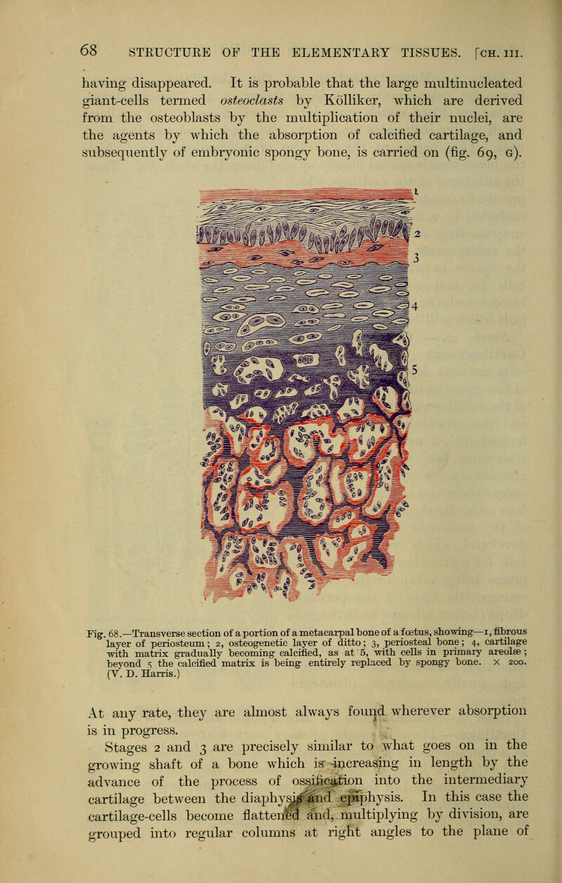 having disappeared. It is probable that the large multinucleated giant-cells termed osteoclasts by Kolliker, which are derived from the osteoblasts by the multiplication of their nuclei, are the agents by which the absorption of calcified cartilage, and subsequently of embryonic spongy bone, is carried on (fig. 69, g). Fig. 68.—Transverse section of a portion of a metacarpal bone of a foetus, showing—i, fibrous layer of periosteum; 2, osteogenetic layer of ditto; 3, periosteal bone; 4, cartilage with matrix gradually becoming calcified, as at 5, with cells in primary areolae; beyond =; the calcified matrix is being entirely replaced by spongy bone, x 200. (V. D. Harris.) At any rate, they are almost always found wherever absorption is in progress. Stages 2 and 3 are precisely similar to what goes on in the growing shaft of a bone which is increasing in length by the advance of the process of ossification into the intermediary cartilage between the diaphysis and epiphysis. In this case the cartilage-cells become flattened and, multiplying by division, are grouped into regular columns at right angles to the plane of