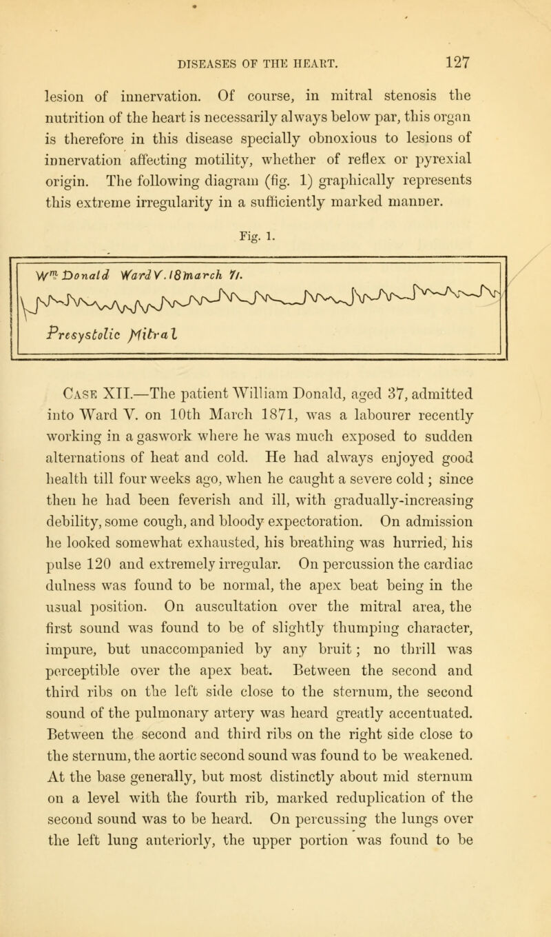 lesion of innervation. Of course, in mitral stenosis the nutrition of the heart is necessarily always below par, this organ is therefore in this disease specially obnoxious to lesions of innervation affecting motility, whether of reflex or pyrexial origin. The following diagram (fig. 1) graphically represents this extreme irregularity in a sufficiently marked manner. rig. 1. W* Donald WardV.l8toarch //. Presystolic f^itraX Case XII.—The patient William Donald, aged 37, admitted into Ward V. on 10th March 1871, was a labourer recently working in a gaswork where he was much exposed to sudden alternations of heat and cold. He had always enjoyed good health till four weeks ago, when he caught a severe cold ; since then he had been feverish and ill, with gradually-increasing debility, some cough, and bloody expectoration. On admission he looked somewhat exhausted, his breathing was hurried, his pulse 120 and extremely irregular. On percussion the cardiac dulness was found to be normal, the apex beat being in the usual position. On auscultation over the mitral area, the first sound was found to be of slightly thumping character, impure, but unaccompanied by any bruit; no thrill was perceptible over the apex beat. Between the second and third ribs on the left side close to the sternum, the second sound of the pulmonary artery was heard greatly accentuated. Between the second and third ribs on the right side close to the sternum, the aortic second sound was found to be weakened. At the base generally, but most distinctly about mid sternum on a level with the fourth rib, marked reduplication of the second sound was to be heard. On percussing the lungs over the left lung anteriorly, the upper portion was found to be