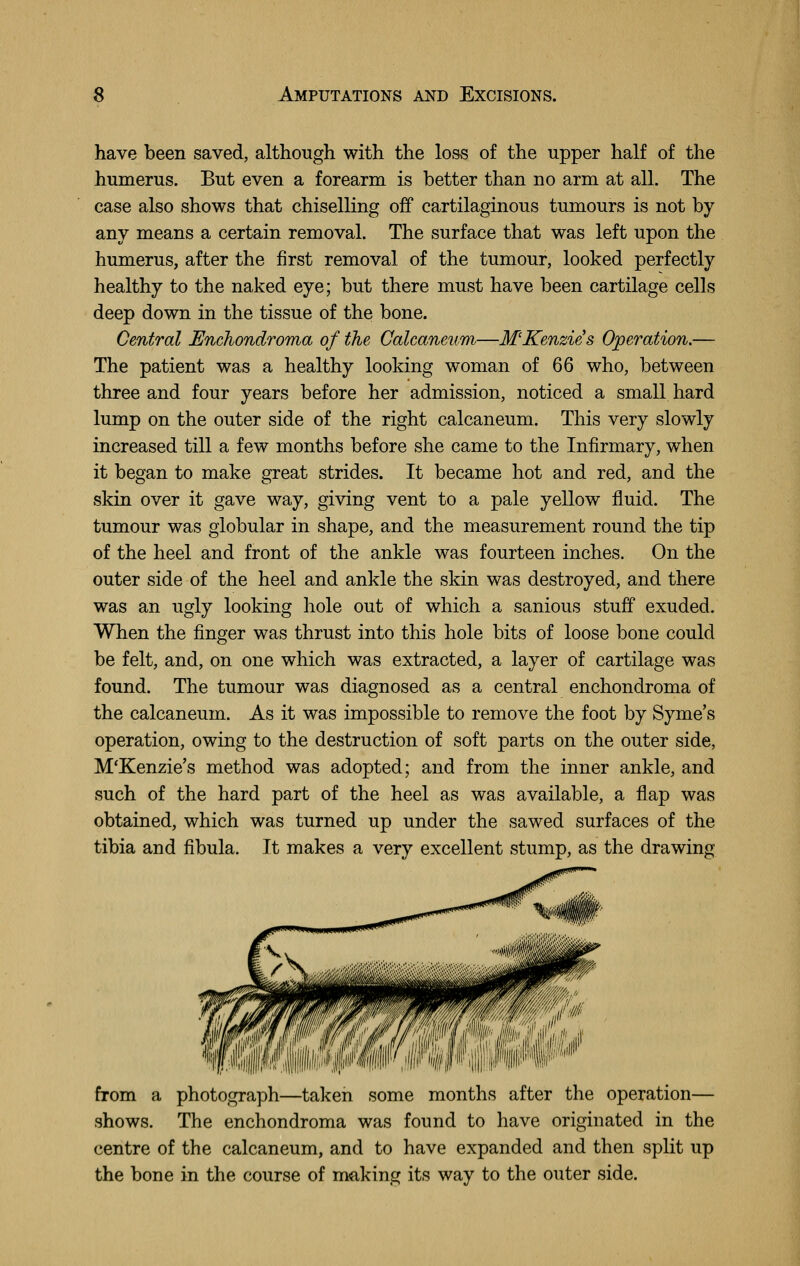 have been saved, although with the loss of the upper half of the humerus. But even a forearm is better than no arm at all. The case also shows that chiselling off cartilaginous tumours is not by any means a certain removal. The surface that was left upon the humerus, after the first removal of the tumour, looked perfectly healthy to the naked eye; but there must have been cartilage cells deep down in the tissue of the bone. Central Enchondroma of the Calcaneitm—MKenzies Operation.— The patient was a healthy looking woman of 66 who, between three and four years before her admission, noticed a small hard lump on the outer side of the right calcaneum. This very slowly increased till a few months before she came to the Infirmary, when it began to make great strides. It became hot and red, and the skin over it gave way, giving vent to a pale yellow fluid. The tumour was globular in shape, and the measurement round the tip of the heel and front of the ankle was fourteen inches. On the outer side of the heel and ankle the skin was destroyed, and there was an ugly looking hole out of which a sanious stuff exuded. When the finger was thrust into this hole bits of loose bone could be felt, and, on one which was extracted, a layer of cartilage was found. The tumour was diagnosed as a central enchondroma of the calcaneum. As it was impossible to remove the foot by Syme's operation, owing to the destruction of soft parts on the outer side, M'Kenzie's method was adopted; and from the inner ankle, and such of the hard part of the heel as was available, a flap was obtained, which was turned up under the sawed surfaces of the tibia and fibula. It makes a very excellent stump, as the drawing from a photograph—taken some months after the operation— shows. The enchondroma was found to have originated in the centre of the calcaneum, and to have expanded and then split up the bone in the course of making its way to the outer side.