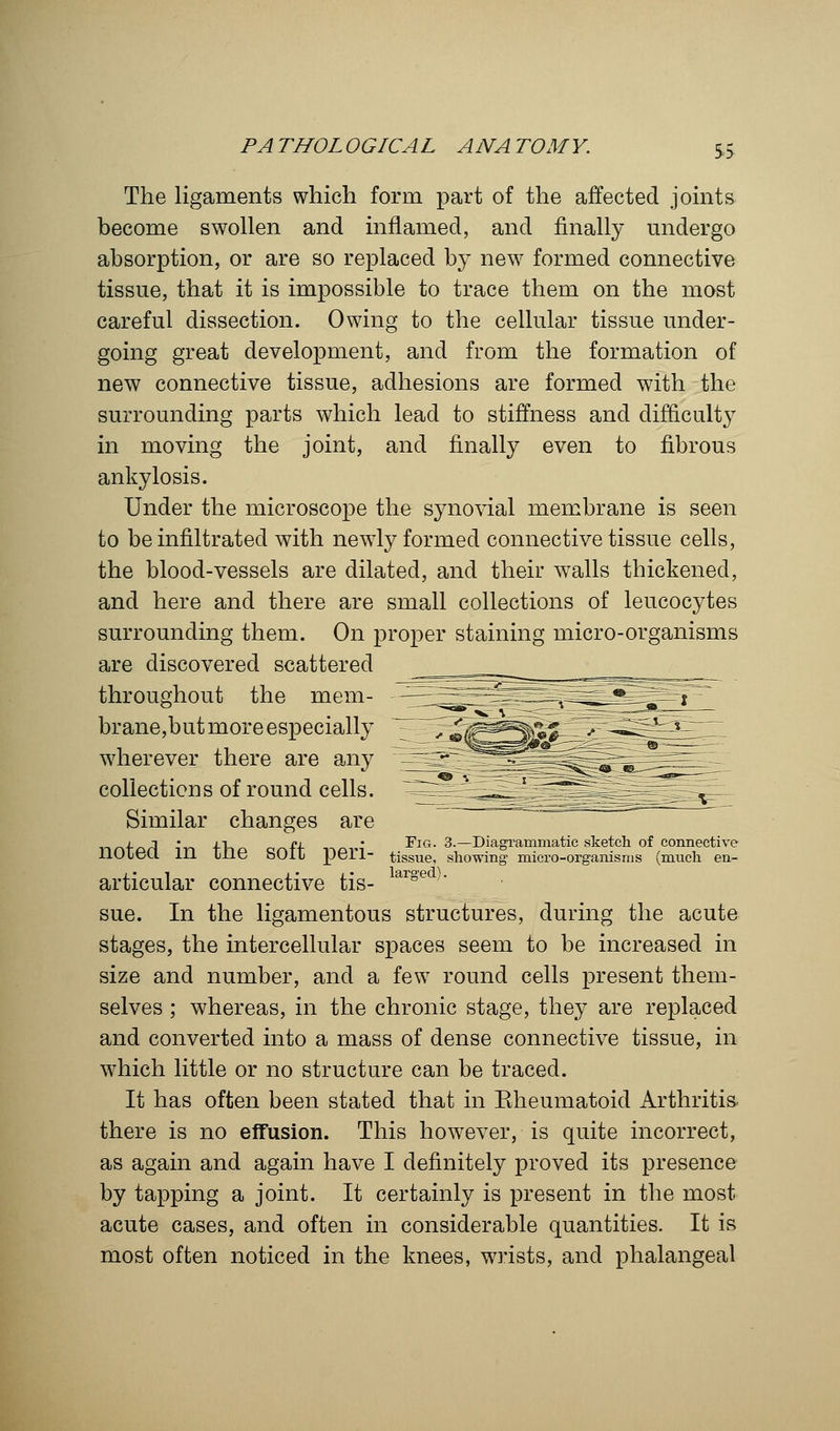 The ligaments which form part of the affected joints become swollen and inflamed, and finally undergo absorption, or are so replaced by new formed connective tissue, that it is impossible to trace them on the most careful dissection. Owing to the cellular tissue under- going great development, and from the formation of new connective tissue, adhesions are formed with the surrounding parts which lead to stiffness and difficulty in moving the joint, and finally even to fibrous ankylosis. Under the microscope the synovial membrane is seen to be infiltrated with newly formed connective tissue cells, the blood-vessels are dilated, and their walls thickened, and here and there are small collections of leucocytes surrounding them. On proper staining micro-organisms are discovered scattered throughout the mem- brane,but more especially wherever there are any collections of round cells. Similar changes are 1 j ■ i-i ar.ff -,-v^v; Fig. 3.—Diagrammatic sketch of connective llOieu. m ine SOIL peri- tissue, showing micro-organisms (much en- articular connective tis- larged)- sue. In the ligamentous structures, during the acute stages, the intercellular spaces seem to be increased in size and number, and a few round cells present them- selves ; whereas, in the chronic stage, they are replaced and converted into a mass of dense connective tissue, in which little or no structure can be traced. It has often been stated that in Eheumatoid Arthritis there is no effusion. This however, is quite incorrect, as again and again have I definitely proved its presence by tapping a joint. It certainly is present in the most acute cases, and often in considerable quantities. It is most often noticed in the knees, wrists, and phalangeal