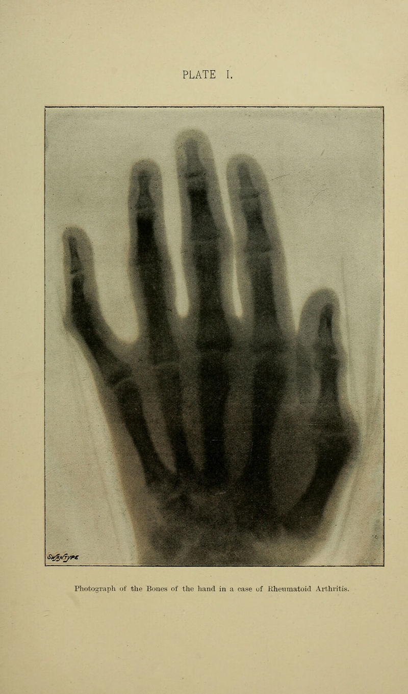 PLATE I. Photograph of the Bones of the hand in a case of Rheumatoid Arthritis.