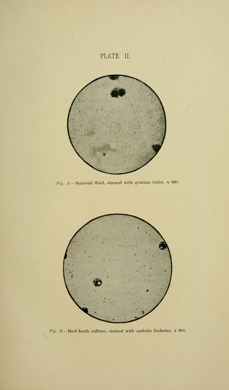 PLATE II. Fir/. ..{.-Synovial fluid, stained with gentian violet, x 900. Fig. 5.—Beef-broth culture, stained with carbolic fuchsine, x 900.