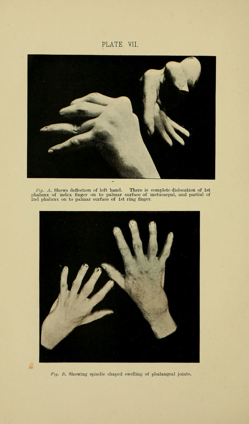 Fig. A. Shows deflection of left hand. There is complete dislocation of 1st phalanx of index finger on to palmar surface of metacarpal, and partial of '2nd phalanx on to palmar surface of 1st ring finger. Fig. B. Showing spindle shaped swelling of phalangeal joints.