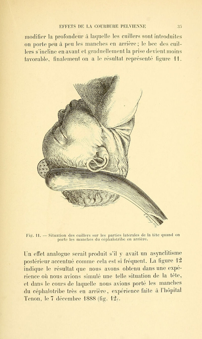 modifior la profondeur à laquello les cuillers sont, introduites on porte peu à peu les manches en arrière ; 1(; bec des cuil- lers s'incline en avant et graduellement la prise devient moins favorable, finalement on a le résultat représenté figure 11. Fig. 11. — Situation des cuillers sur les parties latérales de la tète quand on porte les manches du céphaloLril^e en arrière. Un efîet analogue serait produit s'il y avait un asynclitisme postérieur accentué comme cela est si fréquent. La figure 12 indique le résultat que nous avons obtenu dans une expé- rience oii nous avions simulé une telle situation de la tête, et dans le cours de laquelle nous avions porté les manches du céphalotribe très en arrière, expérience faite à l'hôpital Tenon, le 7 décembre 1888 (fig. 12/.