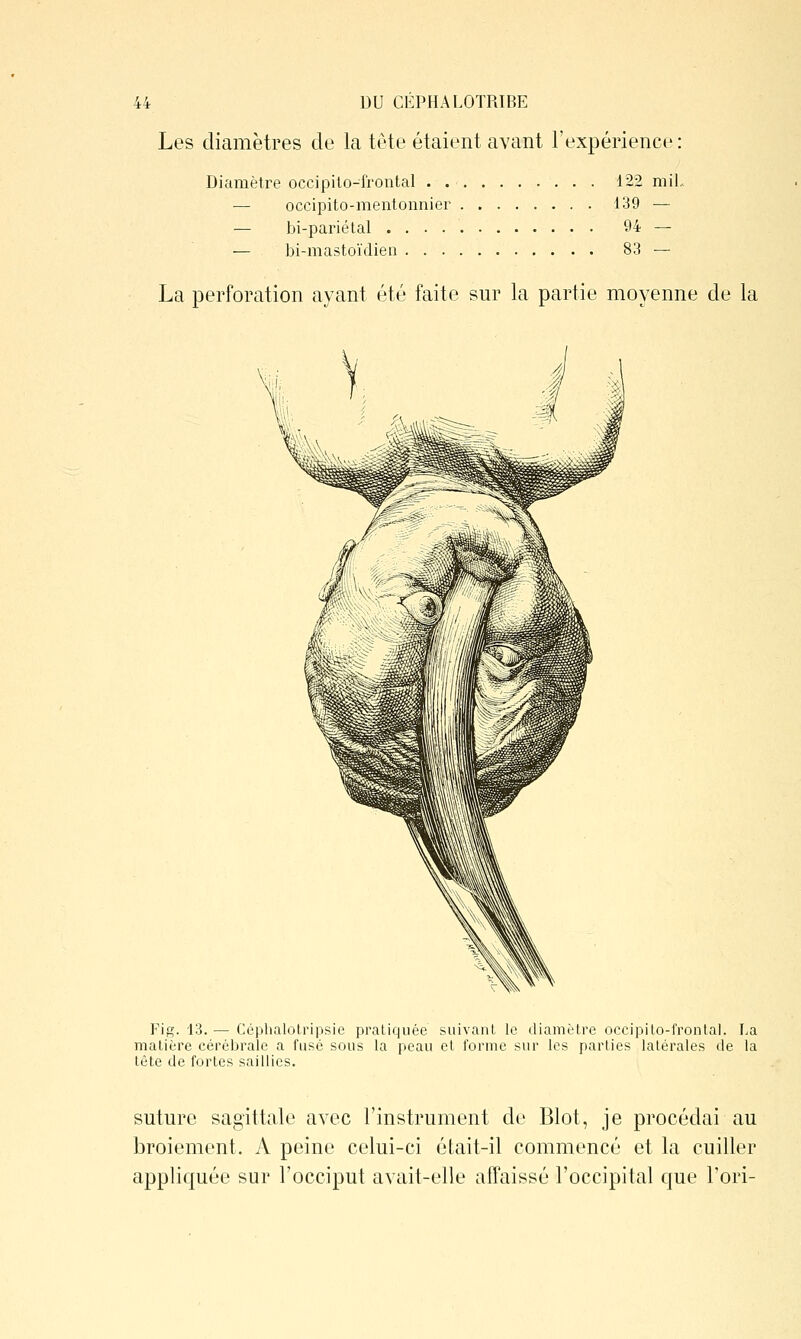 \k DU CÉPHALOTRIBE Les diamètres de la tête étaient avant l'expérience : Diamètre occipito-frontal . 122 niiL — occipito-mentonnier 139 — — bi-pariétal 94 ^ — bi-mastoïdien 83 — La perforation ayant été faite sur la partie moyenne de la Fiff. 13. — Céplialolripsie pratiquée suivanl le diamètre occipilo-frontal. La matière céréijraie a fusé sous la peau et forme sur les parties latérales de la tête de fortes saillies. sutm^e sagittale avec l'instrument de Blot, je procédai au broiement. A peine celui-ci était-il commencé et la cuiller appliquée sur l'occiput avait-elle affaissé l'occipital cjue l'ori-