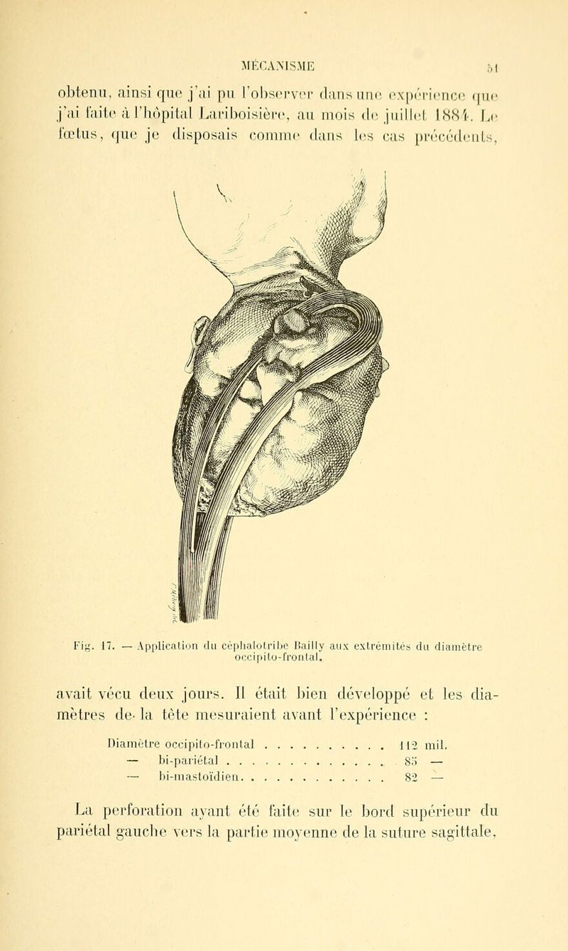 oi obtenu, ainsi que j'ai pu robscrvcr dans une, cx-ix-i'icncc (pic j'ai faite à l'hôpital Lai'iboisièrc, au mois d(3 juillet 1884'. Ln fœtus, que je disposais comme tians les cas précédents, u il Il É II il Mi' Fig. 17. — Application du céphalotribe Bailly aux extrémités du diamètre occipilo-fronlal. avait vécu deux jours. Il était bien développé et les dia- mètres de- la tête mesuraient avant l'expérience : Diamètre occipito-frontal 112 mil. — bi-pariéta] S.'î — — bi-mastoïdien 82 — La perforation ayant été faite sur le bord supérieur du pariétal gauche vers la partie moyenne de la suture sagittale.