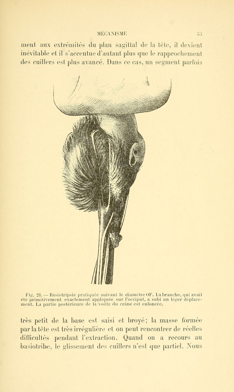 MKCAMSMI>: ment aux extréniii/'s du plan sa*^'iUal d(î la IcLc, il dcvicnil inévitable et il s'accentue d'autant plus que 1(^ rapprocluînient des cuillers est plus avancé. Dans ce cas, un segmeni paiTois Fig. 21. — Basiotripsie pratiquée suivanL le diamètreOF. Labranche, qui avait été primitivement exactement appliquée sur l'occiput, a subi un léger déplace- ment. La partie postérieure do la voûte du crâne est enfoncée. très petit de la base est saisi et broyé; la masse formée par la tête est très irrégulière et on peut rencontrer de réelles difficultés pendant l'extraction. Quand on a recours au basiotribe, le glissement des cuillers n'est que partiel. Nous