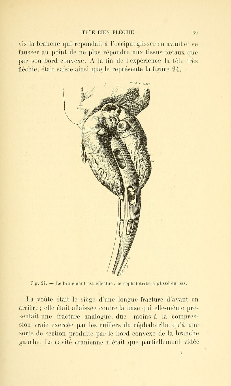 ti:te niEN fij-xiitk vis la branche qui répondait à l'occipuL glisser on avant et se fausser au point de ne plus répondre aux tissus fœtaux que par son bord convexe. A la fm de l'expérience la tête très fléchie, était saisie ainsi que le représente la figure 24. Fig. 24. — Le broiement est effectué : le céphalotribc a glissé en bas. La voûte était le siège d'une longue fracture d'avant en arrière; elle était affaissée contre la base qui elle-même pré- sentait une fracture analogue, due moins à la compres- sion vraie exercée par les cuillers du céphalotribe qu'à une sorte de section produite par le bord convexe de la branche gauche. La cavité crânienne n'était que partiellement vidée