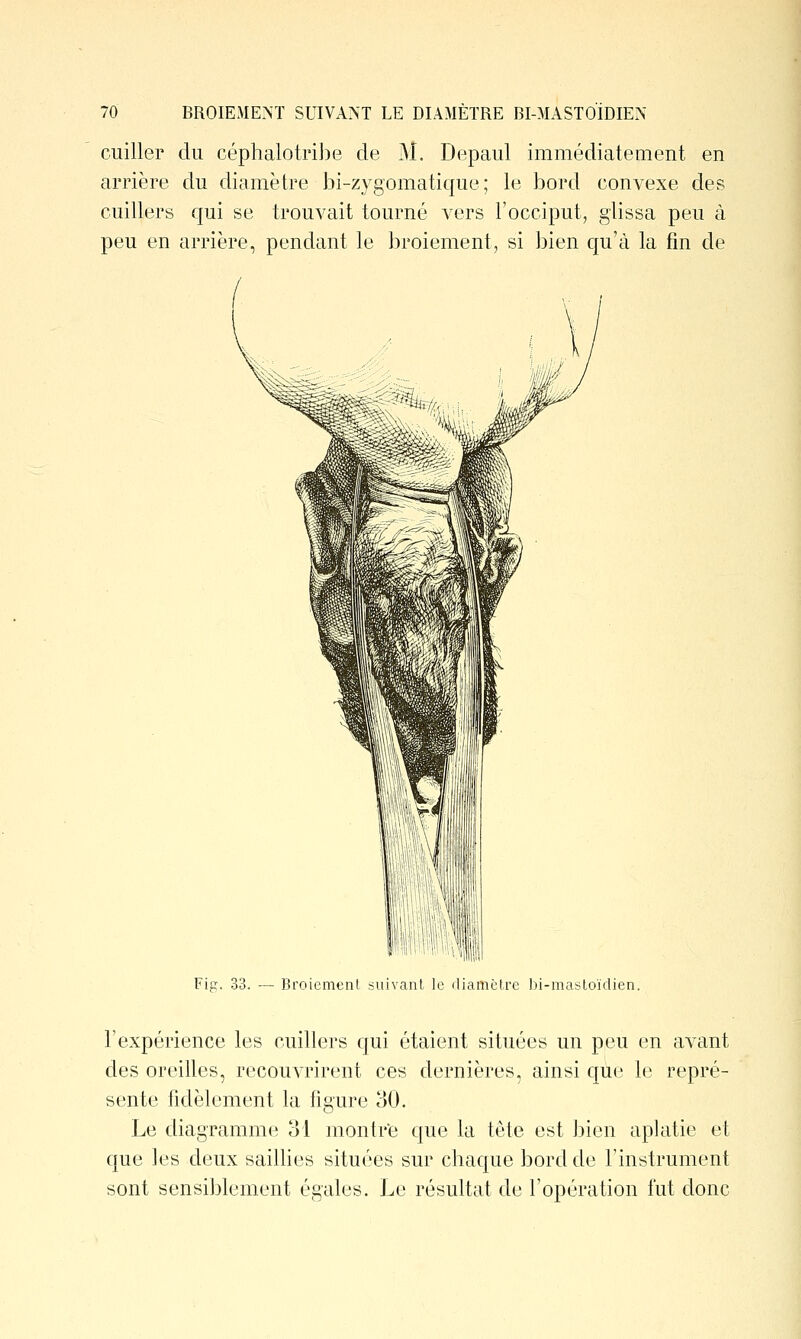 cuiller du céphalotri])e de M. Depaul immédiatement en arrière du diamètre bi-zygomatique ; le bord convexe des cuillers qui se trouvait tourné vers l'occiput, glissa peu à peu en arrière, pendant le broiement, si bien qu'à la fin de Fip. 33. — Broiement suivant le diamètre bi-mastoïdien. l'expérience les cuillers qui étaient situées un peu en avant des oreilles, recouvrirent ces dernières, ainsi que le repré- sente fidèlement la figure 30. Le diagramme ol montre que la tête est bien aplatie et que les deux saillies situées sur chaque bord de l'instrument sont sensiblement égales. Le résultat de l'opération fut donc