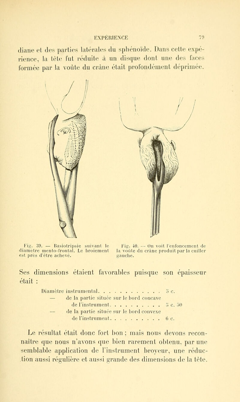 diane ot des parties latérales da sphénoïde. Dans cette expé- rience, la tète lut réduite à un disque dont une des laces formée par la voûte du crâne était profondément déprimée. Fig. 39. — Basiolripsie suivant le Fig. 40. — On voit l'enfoncement de diamètre menlo-f'rontal. Le broiement la vôùte du crâne produit par la cuiller est près d'être achevé. gauche. Ses dimensions étaient favorables puisque son épaisseur était : Diamètre instrumental oc. — de la partie située sur le bord concave de l'instrument 5 c. oO — de la partie située sur le bord convexe de l'instrument 6 c. Le résultat était donc fort bon ; mais nous devons recon- naître que nous n'avons que bien rarement obtenu, par une semblable application de l'instrument broyeur, une réduc- ,tion aussi régulière et aussi grande des dimensions de la tête.