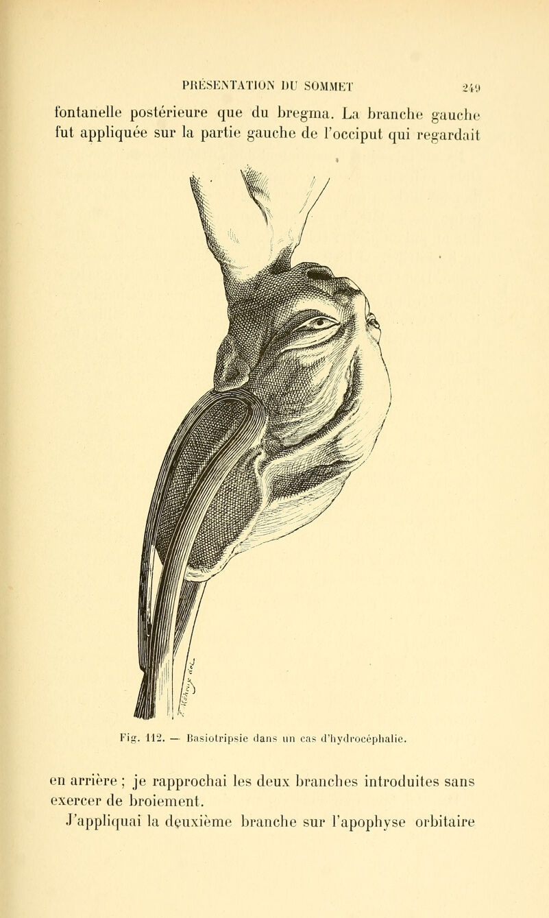 fontanelle postérieure que du bregma. La branche gaucho fut appliquée sur la partie gauche de l'occiput qui regardait Fig. 112. — Basiotripsie dans un cas d'hydrocéplialie. en arrière ; je rapprochai les deux branches introduites sans exercer de broiement. J'appliquai la deuxième branche sur l'apophyse orbitaire