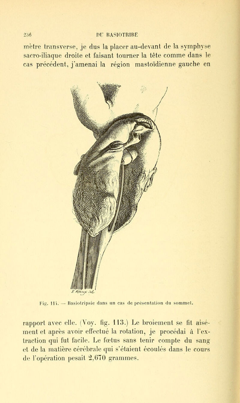 mètre transverse, je dus la placer au-devant de la symphyse sacro-iliaque droite et faisant tourner la tête comme dans le cas précédent, j'amenai la région mastoïdienne gauche en Fig. H'i. — Basiotripsie dans un cas de présentation du sommet. rapport avec elle. (Voy. fig. 113.) Le broiement se fit aisé- ment et après avoir effectué la rotation, je procédai à l'ex- traction qui fut facile. Le fœtus sans tenir compte du sang et de la matière cérébrale qui s'étaient écoulés dans le cours de l'opération pesait 2,670 grammes.