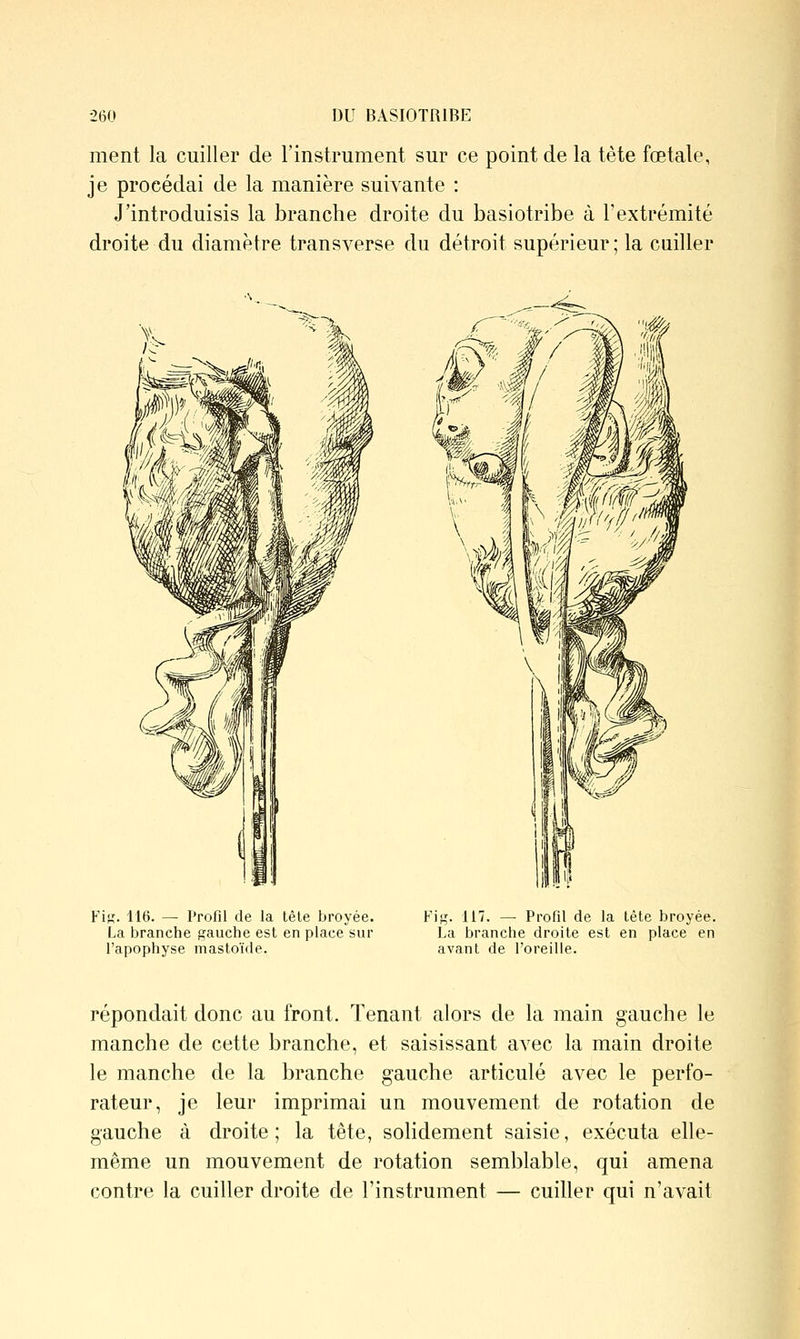 ment la cuiller de l'instrument sur ce point de la tête fœtale, je procédai de la manière suivante : J'introduisis la branche droite du basiotribe à l'extrémité droite du diamètre transverse du détroit supérieur; la cailler Fi},'- 116. — Profil de la tèle broyée. La branche gauche est en place sur l'apophyse mastoïde. Fig. 117. — Profil de la tête broyée. La branche droite est en place en avant de l'oreille. répondait donc au front. Tenant alors de la main gauche le manche de cette branche, et saisissant avec la main droite le manche de la branche gauche articulé avec le perfo- rateur, je leur imprimai un mouvement de rotation de gauche à droite; la tête, solidement saisie, exécuta elle- même un mouvement de rotation semblable, qui amena contre la cuiller droite de l'instrument — cuiller qui n'avait