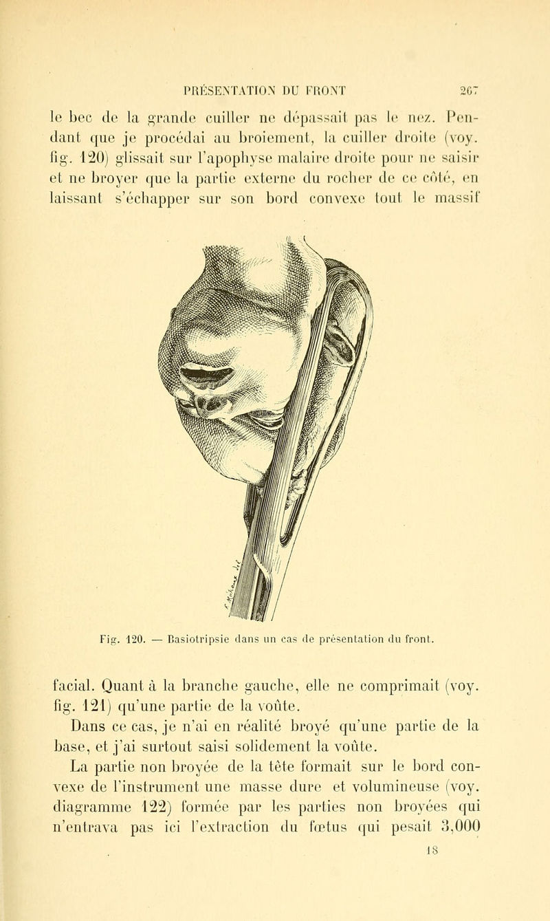 PRÉSENTATION DU FI50NT 2G7 le bec do la grande cuiller ne dépassait pas le nez. Vmi- dant que je procédai au broiement, la cuiller droite (voy. fig. 1^0) glissait sur l'apophyse malaire droite pour ne saisir et ne broyer que la partie externe du rocher de ce côté, en laissant s'échapper sur son bord convexe tout le massif Fig. 120. — Basiotripsie dans un cas de présentation du front. facial. Quanta la branche gauche, elle ne comprimait (voy. fig. 121) qu'une partie de la voûte. Dans ce cas, je n'ai en réalité broyé qu'une partie de la base, et j'ai surtout saisi solidement la voûte. La partie non broyée de la tête formait sur le bord con- vexe de l'instrument une masse dure et volumineuse (voy. diagramme 122) formée par les parties non broyées qui n'entrava pas ici l'extraction du fœtus qui pesait 3,000 18