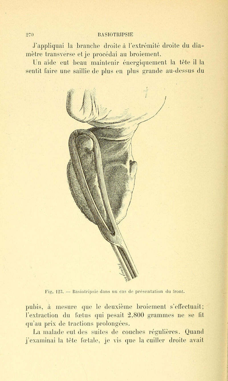 J'appliquai la branche droite à l'extrémité droite du dia- mètre transverse et je procédai au broiement. Un aide eut beau maintenir énergiquement la tête il la sentit faire une saillie de plus en plus grande au-dessus du Fig. 123. — BasioLripsie dans un cas de présentation du front. pubis, à mesure que le deuxième broiement s'effectuait; l'extraction du fœtus qui pesait 2,800 grammes ne se fit qu'au prix de tractions prolongées. La malade eut des suites de couches régulières. Quand j'examinai la tête fœtale, je vis que la cuiller droite avait