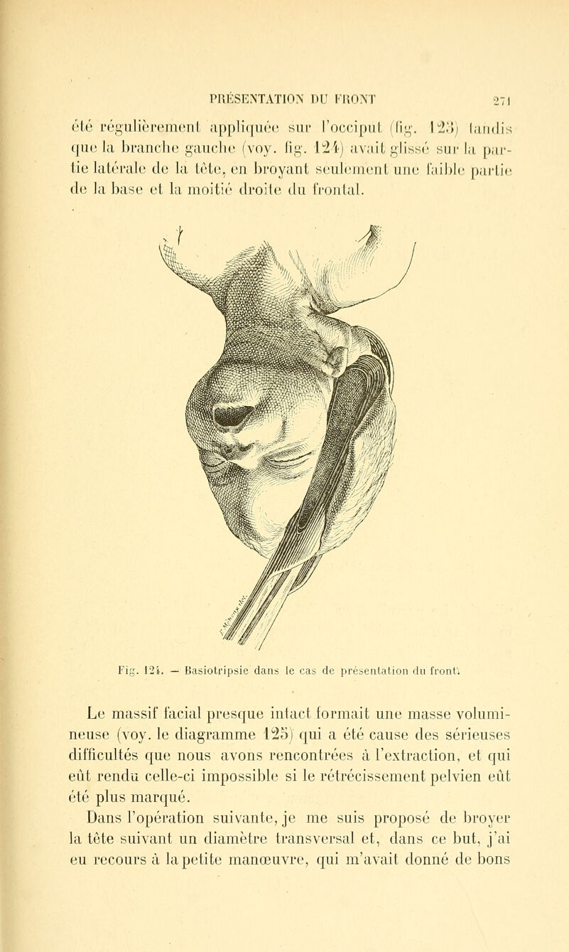 été réguliéi'cincnl ;ippli(|ué(' sni* l'occipul, (fi,^'. [%>) lundis qiu', la l)L'aiicli(' i^aiiclio (voy. liii,-. {M) avait glissé sur la pai*- tie latérale do la této, on broyant soulumont iiik; l'iiibic [)ai'ti(; do la baso ot la moitié droilo du frontal. J Fig. 12i. — Basiotripsie dans le cas de présentation du front; Le massif facial presque intact formait une masse volumi- neuse (voy. le diagramme 125) qui a été cause des sérieuses difficultés que nous avons rencontrées à l'extraction, et qui eut rendu celle-ci impossible si le rétrécissement pelvien eût été plus marqué. Dans l'opération suivante, je me suis proposé de broyer la tête suivant un diamètre transversal et, dans ce but, j'ai ou recours à la petite manœuvre, qui m'avait donné de bons