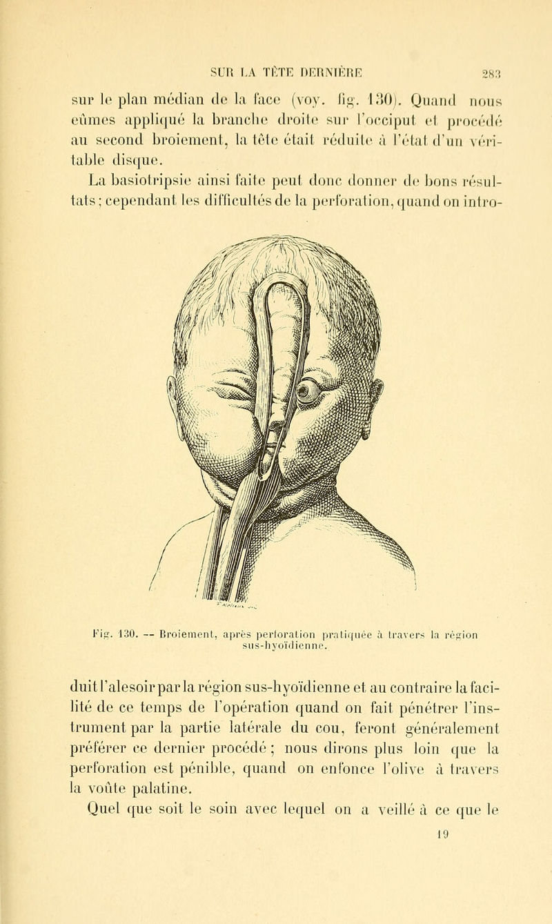 SUR I-A TI'TE DRRNTÈnr: sur lo plan médian do la lace (voy. lin. DU)), Quiuid nous eûmes appliqué la branche droite sur l'oeciput el procédé au second broiement, la têt(5 était réduite à l'état d'un véri- table dis([ue. La basiotripsie ainsi faite peut donc donner de bons résul- tats ; cependant les difficultés de la perforation, quand on intro- Fifï. 130. — Broiement, après perioration pratiquée à travers la région sus-hyoïdienne. duitl'alesoir par la région sus-hyoïdienne et au contraire la faci- lité de ce temps de l'opération quand on fait pénétrer l'ins- trument par la partie latérale du cou, feront généralement préférer ce dernier procédé ; nous dirons plus loin que la perforation est pénible, quand on enfonce l'olive à travers la voûte palatine. Quel que soit le soin avec lequel on a veillé à ce que le 19