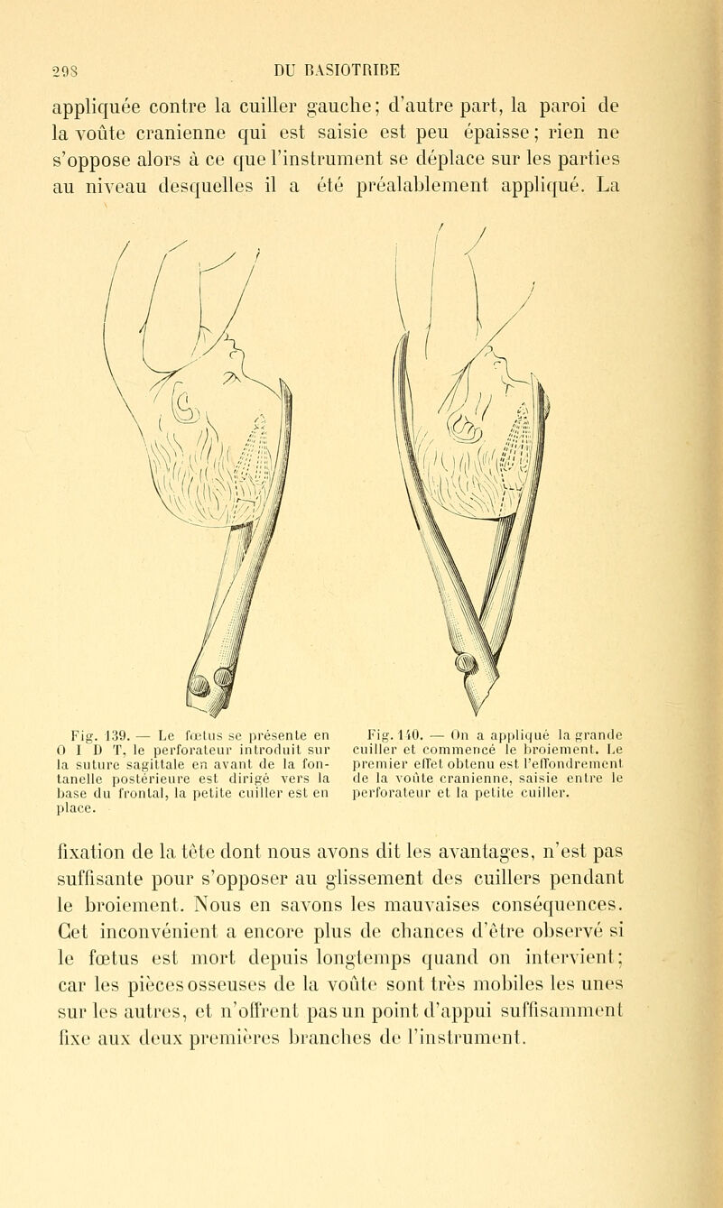 appliquée contre la cuiller gauche; d'autre part, la paroi de la voûte crânienne qui est saisie est peu épaisse ; rien ne s'oppose alors à ce que l'instrument se déplace sur les parties au niveau desquelles il a été préalablement appliqué. La Fig. 139. — Le fœlus se présente en 0 I D T, le perforateur introduit sur la suture sagittale en avant de la fon- tanelle postérieure est dirigé vers la base du frontal, la petite cuiller est en place. Fig. 140. — On a appliqué la grande cuiller et commencé le broiement. Le premier effet obtenu est l'elTondrement de la voûte crânienne, saisie entre le perforateur et la petite cuiller. fixation de la tête dont nous avons dit les avantages, n'est pas suffisante pour s'opposer au glissement des cuillers pendant le broiement. Nous en savons les mauvaises conséquences. Cet inconvénient a encore plus de chances d'être observé si le fœtus est mort depuis longtemps quand on intervient; car les pièces osseuses de la voûte sont très mobiles les unes sur les autres, et n'offrent pas un point d'appui suffisamment fixe aux deux premières branches de l'instrument.