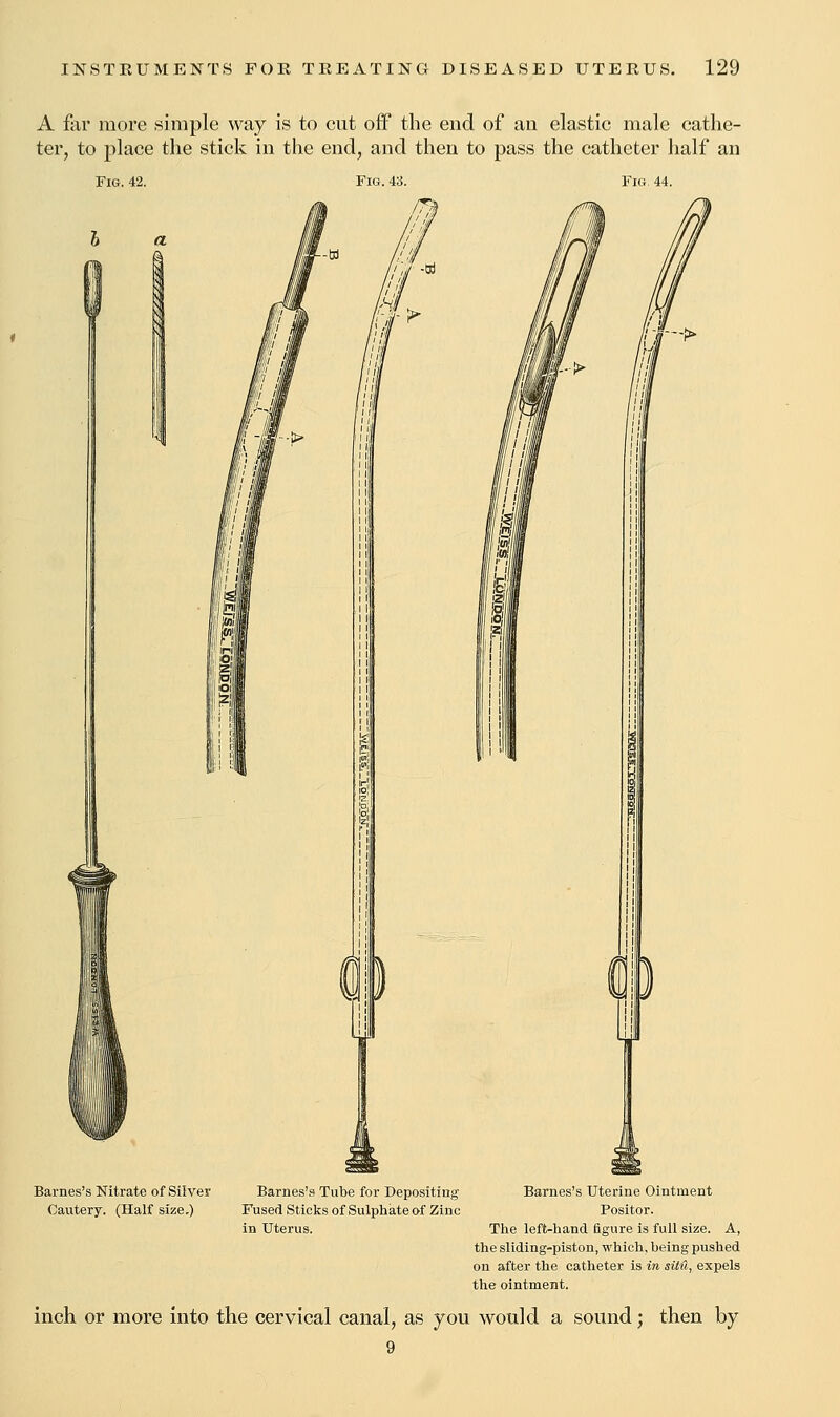 A far more simple way is to cut off the end of an elastic male cathe- ter, to place the stick in the end, and then to pass the catheter half an Fig. 42. Fig 44. Barnes's Nitrate of Silver Cautery. (Half size.) Barnes's Tube for Depositing Fused Sticks of Sulphate of Zinc in Uterus. Barnes's Uterine Ointment Positor. The left-hand figure is full size. A, the sliding-piston, which, being pushed on after the catheter is in situ, expels the ointment. inch or more into the cervical canal, as you would a sound; then by 9