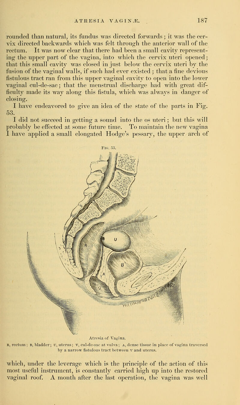 rounded than natural, its fundus was directed forwards ; it was the cer- vix directed backwards which was felt through the anterior wall of the rectum. It was now clear that there had been a small cavity represent- ing the upper part of the vagina, into which the cervix uteri opened; that this small cavity was closed in just below the cervix uteri by the fusion of the vaginal walls, if such had ever existed ; that a fine devious fistulous tract ran from this upper vaginal cavity to open into the lower vaginal cul-de-sac; that the menstrual discharge had with great dif- ficulty made its way along this fistula, which was always in danger of closing. I have endeavored to give an idea of the state of the parts in Fig. 53. I did not succeed in getting a sound into the os uteri; but this will probably be effected at some future time. To maintain the new vagina I have applied a small elongated Hodge's pessary, the upper arch of Fig. 53. Atresia of Vagina. R. rectum ; b, bladder; u, uterus; v, cul-de-sac at vulva; a, dense tissue in place of vagina traversed by a narrow fistulous tract between v and uterus. which, under the leverage which is the principle of the action of this most useful instrument, is constantly carried high up into the restored vaginal roof. A month after the last operation, the vagina was well