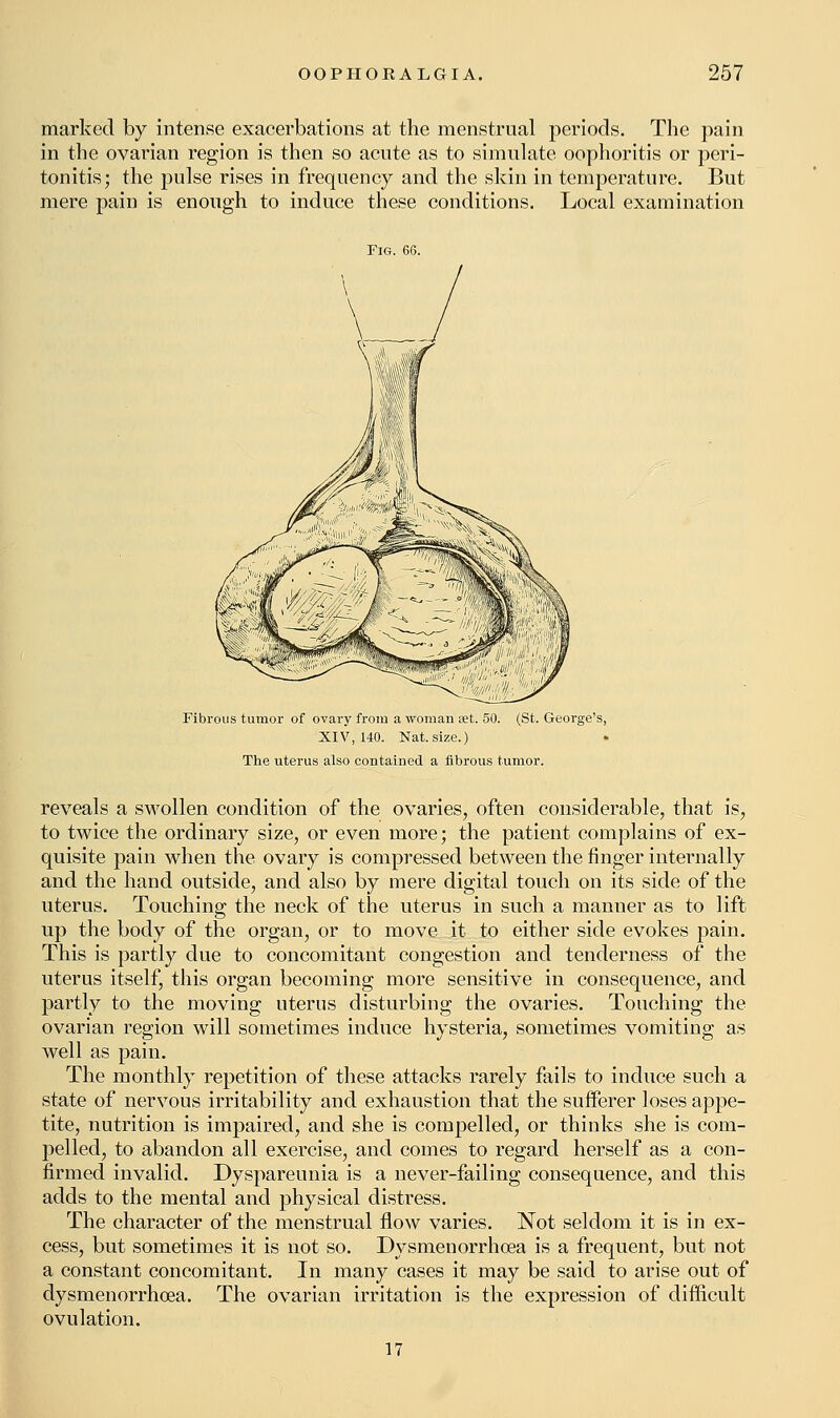 marked by intense exacerbations at the menstrual periods. The pain in the ovarian region is then so acute as to simulate oophoritis or peri- tonitis; the pulse rises in frequency and the skin in temperature. But mere pain is enough to induce these conditions. Local examination Fig. 66. Fibrous tumor of ovary from a woman eet. 50. (St. George's, XIV, 140. Nat. size.) The uterus also contained a fibrous tumor. reveals a swollen condition of the ovaries, often considerable, that is, to twice the ordinary size, or even more; the patient complains of ex- quisite pain when the ovary is compressed between the finger internally and the hand outside, and also by mere digital touch on its side of the uterus. Touching the neck of the uterus in such a manner as to lift up the body of the organ, or to move it to either side evokes pain. This is partly due to concomitant congestion and tenderness of the uterus itself, this organ becoming more sensitive in consequence, and partly to the moving uterus disturbing the ovaries. Touching the ovarian region will sometimes induce hysteria, sometimes vomiting as well as pain. The monthly repetition of these attacks rarely fails to induce such a state of nervous irritability and exhaustion that the sufferer loses appe- tite, nutrition is impaired, and she is compelled, or thinks she is com- pelled, to abandon all exercise, and comes to regard herself as a con- firmed invalid. Dyspareunia is a never-failing consequence, and this adds to the mental and physical distress. The character of the menstrual flow varies. Not seldom it is in ex- cess, but sometimes it is not so. Dysmenorrhoea is a frequent, but not a constant concomitant. In many cases it may be said to arise out of dysmenorrhoea. The ovarian irritation is the expression of difficult ovulation. 17