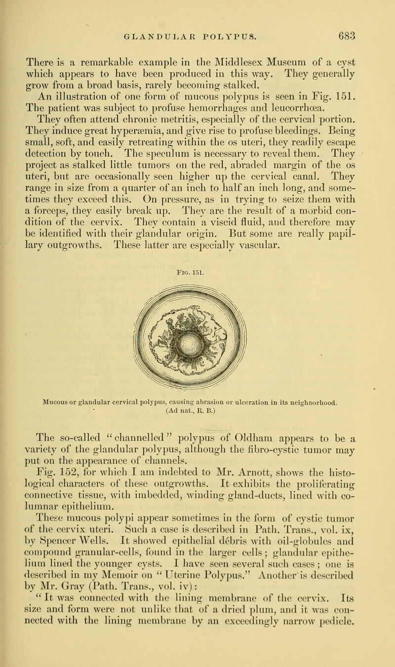 There is a remarkable example in the Middlesex Museum of a cyst which appears to have been produced in this way. They generally grow from a broad basis, rarely becoming stalked. An illustration of one form of mucous polypus is seen in Fig. 151. The patient was subject to profuse hemorrhages and leucorrhcea. They often attend chronic metritis, especially of the cervical portion. They induce great hyperemia, and give rise to profuse bleedings. Being small, soft, and easily retreating within the os uteri, they readily escape detection by touch. The speculum is necessary to reveal them. They project as stalked little tumors on the red, abraded margin of the os uteri, but are occasionally seen higher up the cervical canal. They range in size from a quarter of an inch to half an inch long, and some- times they exceed this. On pressure, as in trying to seize them with a forceps, they easily break up. They are the result of a morbid con- dition of the cervix. They contain a viscid fluid, and therefore may be identified with their glandular origin. But some are really papil- lary outgrowths. These latter are especially vascular. Mucous or glandular cervical polypus, causing abrasion or ulceration in its neighDorhood. (Ad nat., R. B.) The so-called channelled polypus of Oldham appears to be a variety of the glandular polypus, although the fibro-cystic tumor may put on the appearance of channels. Fig. 152, for which I am indebted to Mr. Arnott, shows the histo- logical characters of these outgrowths. It exhibits the proliferating connective tissue, with imbedded, winding gland-ducts, lined with co- lumnar epithelium. These mucous polypi appear sometimes in the form of cystic tumor of the cervix uteri. Such a case is described in Path. Trans., vol. ix, by Spencer Wells. It showed epithelial debris with oil-globules and compound granular-cells, found in the larger cells; glandular epithe- lium lined the younger cysts. I have seen several such cases ; one is described in my Memoir on Uterine Polypus. Another is described by Mr. Gray (Path. Trans., vol. iv): It was connected with the lining membrane of the cervix. Its size and form were not unlike that of a dried plum, and it was con- nected with the lining membrane by an exceedingly narrow pedicle.