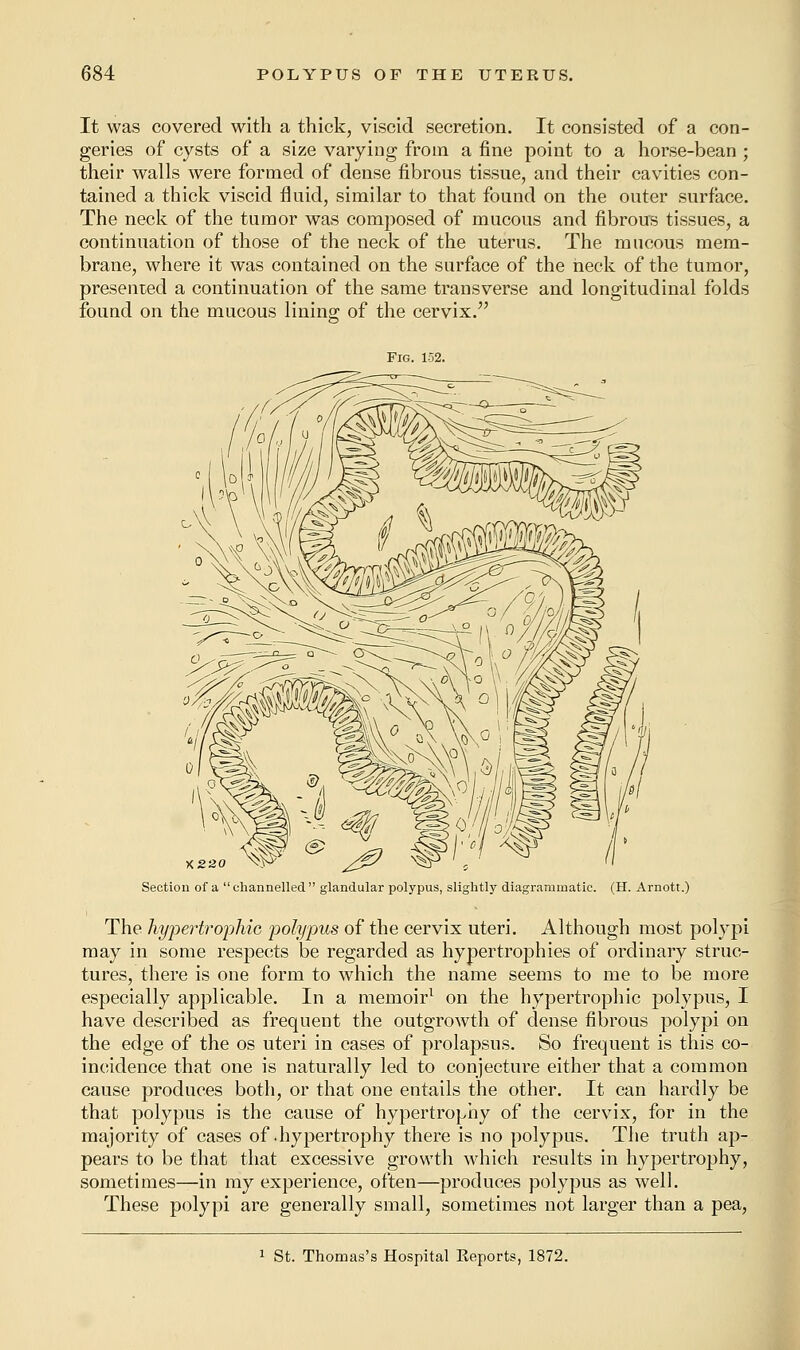 It was covered with a thick, viscid secretion. It consisted of a con- geries of cysts of a size varying from a fine point to a horse-bean ; their walls were formed of dense fibrous tissue, and their cavities con- tained a thick viscid fluid, similar to that found on the outer surface. The neck of the tumor was composed of mucous and fibrous tissues, a continuation of those of the neck of the uterus. The mucous mem- brane, where it was contained on the surface of the neck of the tumor, presented a continuation of the same transverse and longitudinal folds found on the mucous lining of the cervix. Fig. 152. ■x.220 \\v Section of a channelled glandular polypus, slightly diagrammatic. (H. Arnott.) The hypertrophic polypus of the cervix uteri. Although most polypi may in some respects be regarded as hypertrophies of ordinary struc- tures, there is one form to which the name seems to me to be more especially applicable. In a memoir1 on the hypertrophic polypus, I have described as frequent the outgrowth of dense fibrous polypi on the edge of the os uteri in cases of prolapsus. So frequent is this co- incidence that one is naturally led to conjecture either that a common cause produces both, or that one entails the other. It can hardly be that polypus is the cause of hypertrophy of the cervix, for in the majority of cases of .hypertrophy there is no polypus. The truth ap- pears to be that that excessive growth which results in hypertrophy, sometimes—in my experience, often—produces polypus as well. These polypi are generally small, sometimes not larger than a pea, 1 St. Thomas's Hospital Keports, 1872.
