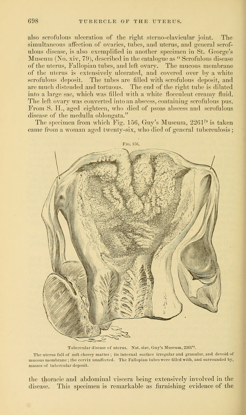 also scrofulous ulceration of the right sterno-clavicular joint. The simultaneous affection of ovaries, tubes, and uterus, and general scrof- ulous disease, is also exemplified in another specimen in St. George's Museum (No. xiv, 79), described in the catalogue as  Scrofulous disease of the uterus, Fallopian tubes, and left ovary. The mucous membrane of the uterus is extensively ulcerated, and covered over by a white scrofulous deposit. The tubes are filled with scrofulous deposit, and are much distended and tortuous. The end of the right tube is dilated into a large sac, which was filled with a white flocculent creamy fluid. The left ovary was converted into an abscess, containing scrofulous pus. From S. H., aged eighteen, who died of psoas abscess and scrofulous disease of the medulla oblongata. The specimen from which Fig. 156, Guy's Museum, 226175 is taken came from a woman aged twenty-six, who died of general tuberculosis; Tubercular disease of uterus. Nat. size, Guy's Museum, 226T The uterus full of soft cheesy matter ; its internal surface irregular and granular, and devoid of mucous membrane ; the cervix unaffected. The Fallopian tubes were filled with, and surrounded by, masses of tubercular deposit. the thoracic and abdominal viscera being extensively involved in the disease. This specimen is remarkable as furnishing evidence of the