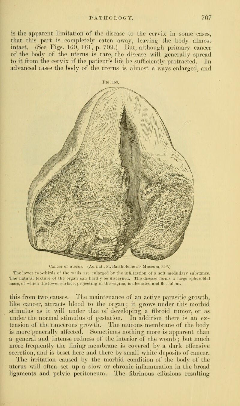 is the apparent limitation of the disease to the cervix in some cases, that this part is completely eaten away, leaving the body almost intact. (See Figs. 160, 161, p. 709.) But, although primary cancer of the body of the uterus is rare, the disease will generally spread to it from the cervix if the patient's life be sufficiently protracted. In advanced cases the body of the uterus is almost always enlarged, and Fig. 158. Cancer of uterus. (Ad nat., St. Bartholomew's Museum, 32.) The lower two-thirds of the walls are enlarged by the infiltration of a soft medullary substance. The natural texture of the organ can hardly be discerned. The disease forms a large spheroidal masx, of which the lower surface, projecting in the vagina, is ulcerated and flocculent. this from two causes. The maintenance of an active parasitic growth, like cancer, attracts blood to the organ ; it grows under this morbid stimulus as it will under thai of developing a fibroid tumor, or as under the normal stimulus of gestation. In addition there is an ex- tension of the cancerous growth. The mucous membrane of the body is more generally affected. Sometimes nothing more is apparent than a general and intense redness of the interior of the womb; but much more frequently the lining membrane is covered by a dark offensive secretion, and is beset here and there by small white deposits of cancer. The irritation caused by the morbid condition of the body of the uterus will often set up a slow or chronic inflammation in the broad ligaments and pelvic peritoneum. The fibrinous effusions resulting