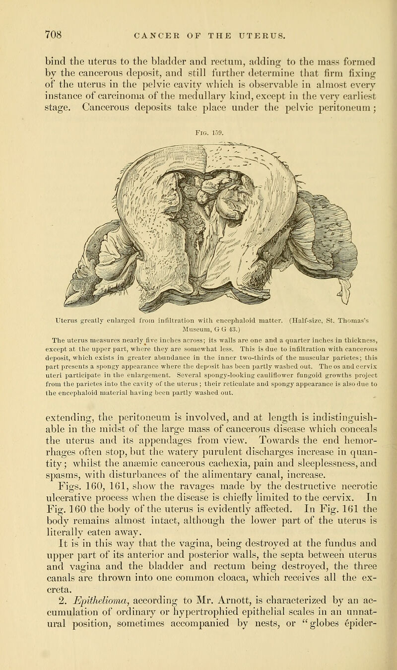 bind the uterus to the bladder and rectum, adding to the mass formed by the cancerous deposit, and still further determine that firm fixing of the uterus in the pelvic cavity which is observable in almost every instance of carcinoma of the medullary kind, except in the very earliest stage. Cancerous deposits take place under the pelvic peritoneum; Fig. 159. Uterus greatly enlarged from infiltration with encephaloid matter. (Half-size, St. Thomas's Museum, G G 43.) The uterus measures nearly five inches across; its walls are one and a quarter inches in thickness, except at the upper part, where they are somewhat less. This is due to infiltration with cancerous deposit, which exists in greater abundance in the inner two-thirds of the muscular parietes; this part presents a spongy appearance where the deposit has been partly washed out. The os and cervix uteri participate in the enlargement. Several spongy-looking cauliflower fungoid growths project from the parietes into the cavity of the uterus ; their reticulate and spongy appearance is also due to the encephaloid material having been partly washed out. extending, the peritoneum is involved, and at length is indistinguish- able in the midst of the large mass of cancerous disease which conceals the uterus and its appendages from view. Towards the end hemor- rhages often stop, but the watery purulent discharges increase in quan- tity ; whilst the anaemic cancerous cachexia, pain and sleeplessness, and spasms, with disturbances of the alimentary canal, increase. Figs. 160, 161, show the ravages made by the destructive necrotic ulcerative process when the disease is chiefly limited to the cervix. In Fig. 160 the body of the uterus is evidently affected. In Fig. 161 the body remains almost intact, although the lower part of the uterus is literally eaten away. It is in this way that the vagina, being destroyed at the fundus and upper part of its anterior and posterior walls, the septa between uterus and vagina and the bladder and rectum being destroyed, the three canals are thrown into one common cloaca, which receives all the ex- creta. 2. Epithelioma, according to Mr. Arnott, is characterized by an ac- cumulation of ordinary or hypertrophied epithelial scales in an unnat- ural position, sometimes accompanied by nests, or globes epider-