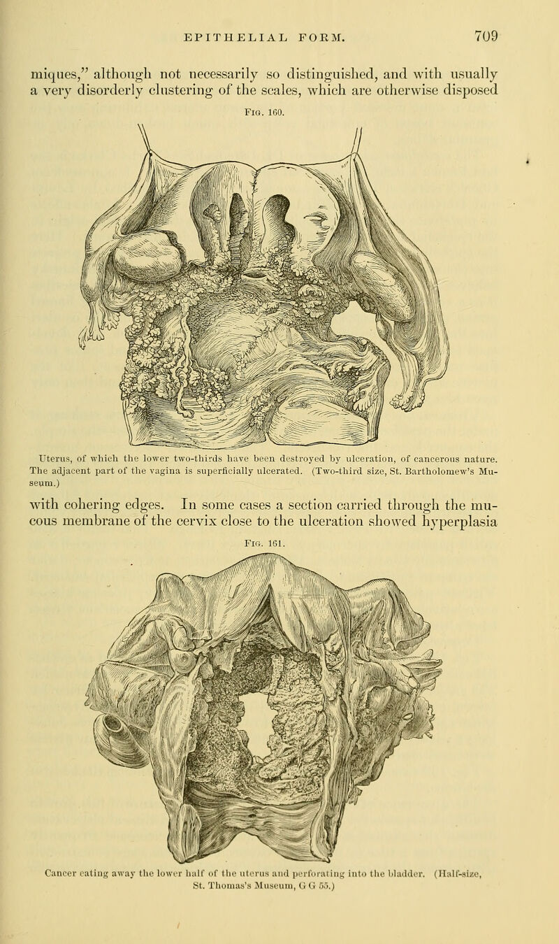 miques, although not necessarily so distinguished, and with usually a very disorderly clustering of the scales, which are otherwise disposed Fig. 160. Uterus, of which the lower two-thirds have been destroyed by ulceration, of cancerous nature. The adjacent part of the vagina is superficially ulcerated. (Two-third size, St. Bartholomew's Mu- seum.) with cohering edges. In some cases a section carried through the mu- cous membrane of the cervix close to the ulceration showed hyperplasia Fig. 161. Cancer eating away the lower half of the uterus and perforating into the Madder. (Half-size, St. Thomas's Museum, (; G 55.)