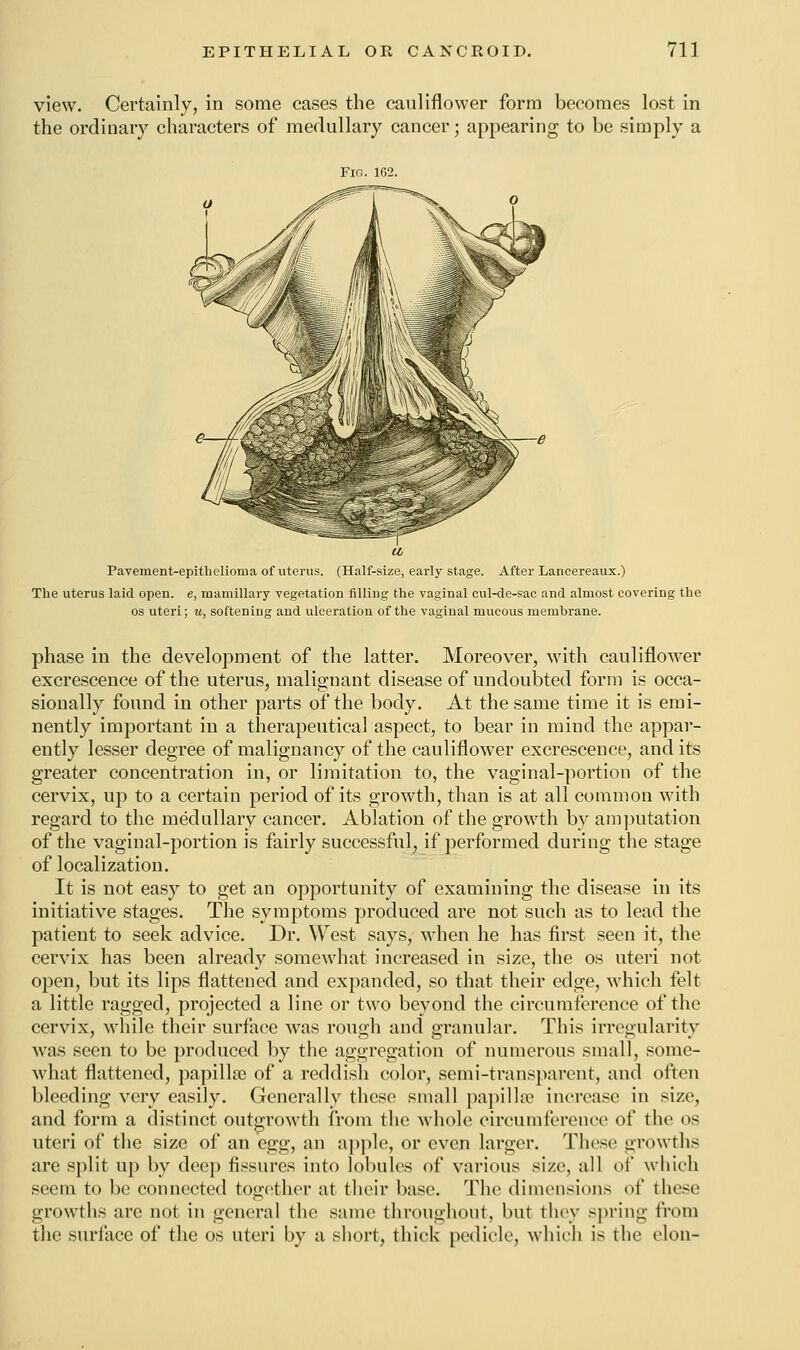 view. Certainly, in some cases the cauliflower form becomes lost in the ordinary characters of medullary cancer; appearing to be simply a Pavement-epitheliorna of uterus. (Half-size, early stage. After Lancereaux.) The uterus laid open, e, mamillary vegetation filling the vaginal cul-de-sac and almost covering the os uteri; u, softening and ulceration of the vaginal mucous membrane. phase in the development of the latter. Moreover, with cauliflower excrescence of the uterus, malignant disease of undoubted form is occa- sionally found in other parts of the body. At the same time it is emi- nently important in a therapeutical aspect, to bear in mind the appar- ently lesser degree of malignancy of the cauliflower excrescence, and its greater concentration in, or limitation to, the vaginal-portion of the cervix, up to a certain period of its growth, than is at all common with regard to the medullary cancer. Ablation of the growth by amputation of the vaginal-portion is fairly successful, if performed during the stage of localization. It is not easy to get an opportunity of examining the disease in its initiative stages. The symptoms produced are not such as to lead the patient to seek advice. Dr. West says, when he has first seen it, the cervix has been already somewhat increased in size, the os uteri not open, but its lips flattened and expanded, so that their edge, which felt a little ragged, projected a line or two beyond the circumference of the cervix, while their surface was rough and granular. This irregularity was seen to be produced by the aggregation of numerous small, some- what flattened, papillae of a reddish color, semi-transparent, and often bleeding very easily. Generally these small papillae increase in size, and form a distinct outgrowth from the whole circumference of the os uteri of the size of an egg, an apple, or even larger. These growths are split up by deep fissures into lobules of various size, all of which seem to be connected together at their base. The dimensions of these growths are not in general the same throughout, but they spring from the surface of the os uteri by a short, thick pedicle, which is the clou-