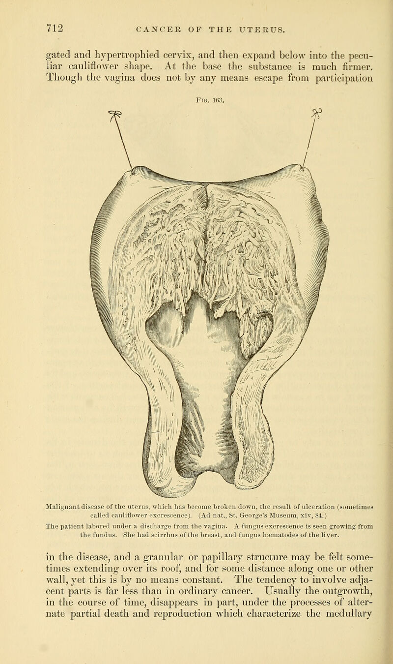 gated and hypertrophied cervix, and then expand below into the pecu- liar cauliflower shape. At the base the substance is much firmer. Though the vagina does not by any means escape from participation Fig. 163. Malignant disease of the uterus, which has become broken down, the result of ulceration (sometimes called cauliflower excrescence). (Ad nat., St. George's Museum, xiv, 84.) The patient labored under a discharge from the vagina. A fungus excrescence is seen growing from the fundus. She had scirrhus of the breast, and fungus hrematodes of the liver. in the disease, and a granular or papillary structure may be felt some- times extending over its roof, and for some distance along one or other wall, yet this is by no means constant. The tendency to involve adja- cent parts is far less than in ordinary cancer. Usually the outgrowth, in the course of time, disappears in part, under the processes of alter- nate partial death and reproduction which characterize the medullary