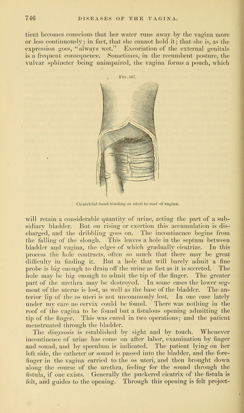 tient becomes conscious that her water runs away by the vagina more or less continuously; in fact, that she cannot hold it; that she is; as the expression goes, always wet. Excoriation of the external genitals is a frequent consequence. Sometimes, in the recumbent posture, the vulvar sphincter being unimpaired, the vagina forms a pouch, which Fig. 167. Cicatricial band binding os uteri to roof of vagina. will retain a considerable quantity of urine, acting the part of a sub- sidiary bladder. But on rising or exertion this accumulation is dis- charged, and the dribbling goes on. The incontinence begins from the falling of the slough. This leaves a hole in the septum between bladder and vagina, the edges of which gradually cicatrize. In this process the hole contracts, often so much that there may be great difficulty in finding it. But a hole that will barely admit a fine probe is big enough to drain off the urine as fast as it is secreted. The hole may be big enough to admit the tip of the finger. The greater part of the urethra may be destroyed. In some cases the lower seg- ment of the uterus is lost, as well as the base of the bladder. The an- terior lip of the os uteri is not uncommonly lost. In one case lately under my care no cervix could be found. There was nothing in the roof of the vagina to be found but a fistulous opening admitting the tip of the finger. This was cured in two operations; and the patient menstruated through the bladder. The diagnosis is established by sight and by touch. Whenever incontinence of urine has come on after labor, examination by finger and sound, and by speculum is indicated. The patient lying on her left side, the catheter or sound is passed into the bladder, and the fore- finger in the vagina carried to the os uteri, and then brought down along the course of the urethra, feeling for the sound through the fistula, if one exists. Generally the puckered cicatrix of the fistula is felt, and guides to the opening. Through this opening is felt project-