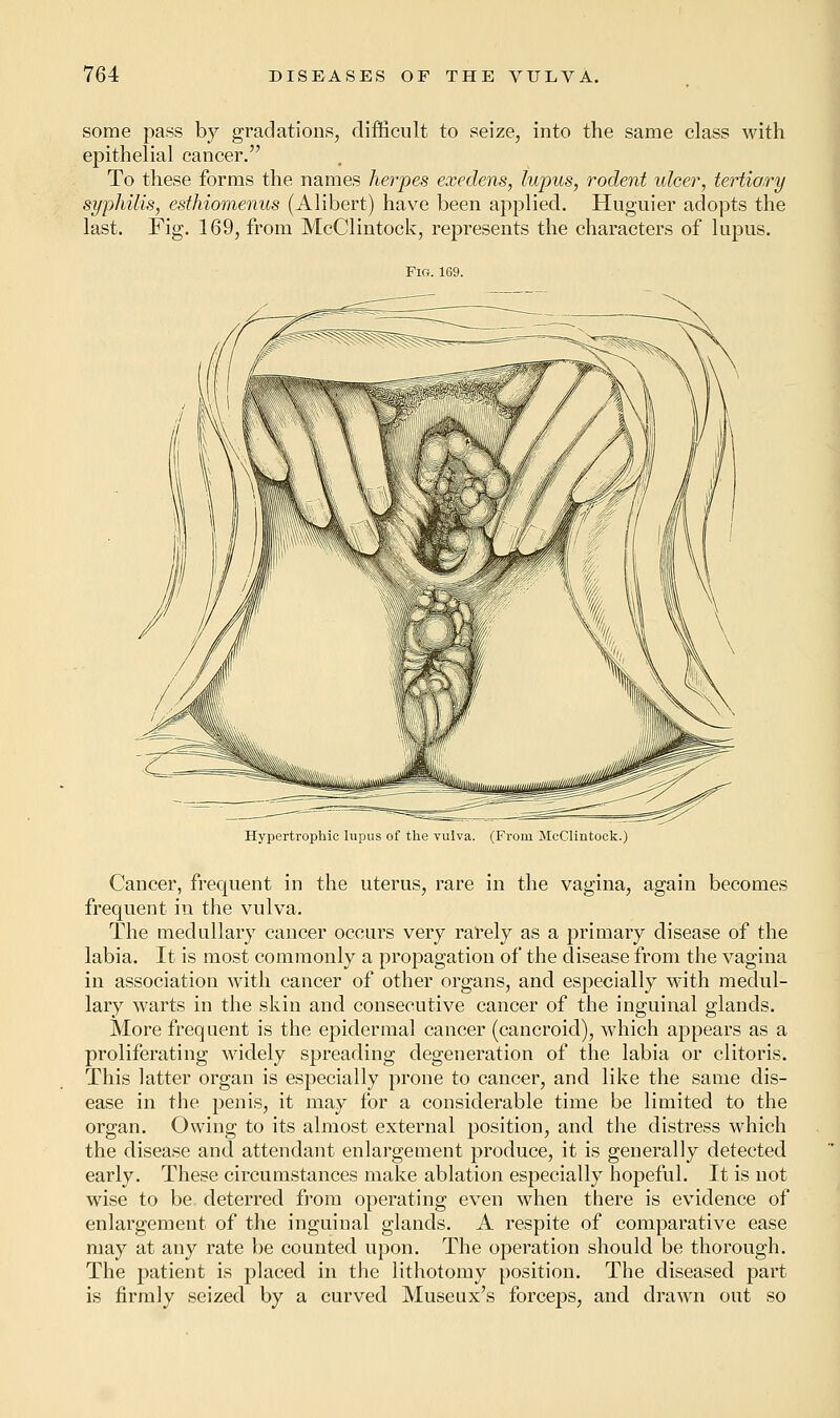 some pass by gradations, difficult to seize, into the same class with epithelial cancer. To these forms the names herpes exedens, lupus, rodent idcer, tertiary syphilis, esthiornenus (Alibert) have been applied. Huguier adopts the last. Fig. 169, from McClintock, represents the characters of lupus. Fig. 169. Hypertrophic lupus of the vulva. (From McClintock.) Cancer, frequent in the uterus, rare in the vagina, again becomes frequent in the vulva. The medullary cancer occurs very rarely as a primary disease of the labia. It is most commonly a propagation of the disease from the vagina in association with cancer of other organs, and especially with medul- lary warts in the skin and consecutive cancer of the inguinal glands. More frequent is the epidermal cancer (cancroid), which appears as a proliferating widely spreading degeneration of the labia or clitoris. This latter organ is especially prone to cancer, and like the same dis- ease in the penis, it may for a considerable time be limited to the organ. Owing to its almost external position, and the distress which the disease and attendant enlargement produce, it is generally detected early. These circumstances make ablation especially hopeful. It is not wise to be deterred from operating even when there is evidence of enlargement of the inguinal glands. A respite of comparative ease may at any rate be counted upon. The operation should be thorough. The patient is placed in the lithotomy position. The diseased part is firmly seized by a curved Museux's forceps, and drawn out so