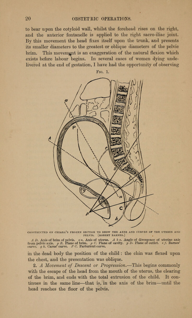to bear upon the cotyloid waU, whilst the forehead rises on the right, and the anterior fontanelle is applied to the right sacro-iliac joint. By this movement the head fixes itself upon the trmik, and presents its smaller diameters to the greatest or oblique diameters of the pelvic brim. This movement is an exaggeration of the natural flexion which exists before labour begins. In several cases of women dying mide- livered at the end of gestation, I have had the opportunity of observing Fig. 1. CONSTRUCTED ON CHIAKA'S FROZEN SECTION TO SHOW THE AXES AND CURVES OF THE UTERUS AND PELVIS. (ROBERT BARNES.) A D. Axis of brim of pelvis, a u. Axis of Titems. Ala. Angle of divergence of uterine axis from pelvic axis, p B. Plane of brim, p C. Plane of cavity, p D. Plane of outlet, ef. Barnes' curve, g h. Carus'curve. PC. Parturient curve. in the dead body the position of the child : the chin was flexed upon the chest, and the presentation was oblique. 2. A Movement of Descent or Progression.—This begins commonly with the escape of the head from the mouth of the uterus, the clearing of the brim, and ends with the total extrusion of the child. It con- tinues in the same line—that is, in the axis of the brim—until the head reaches the floor of the pelvis.