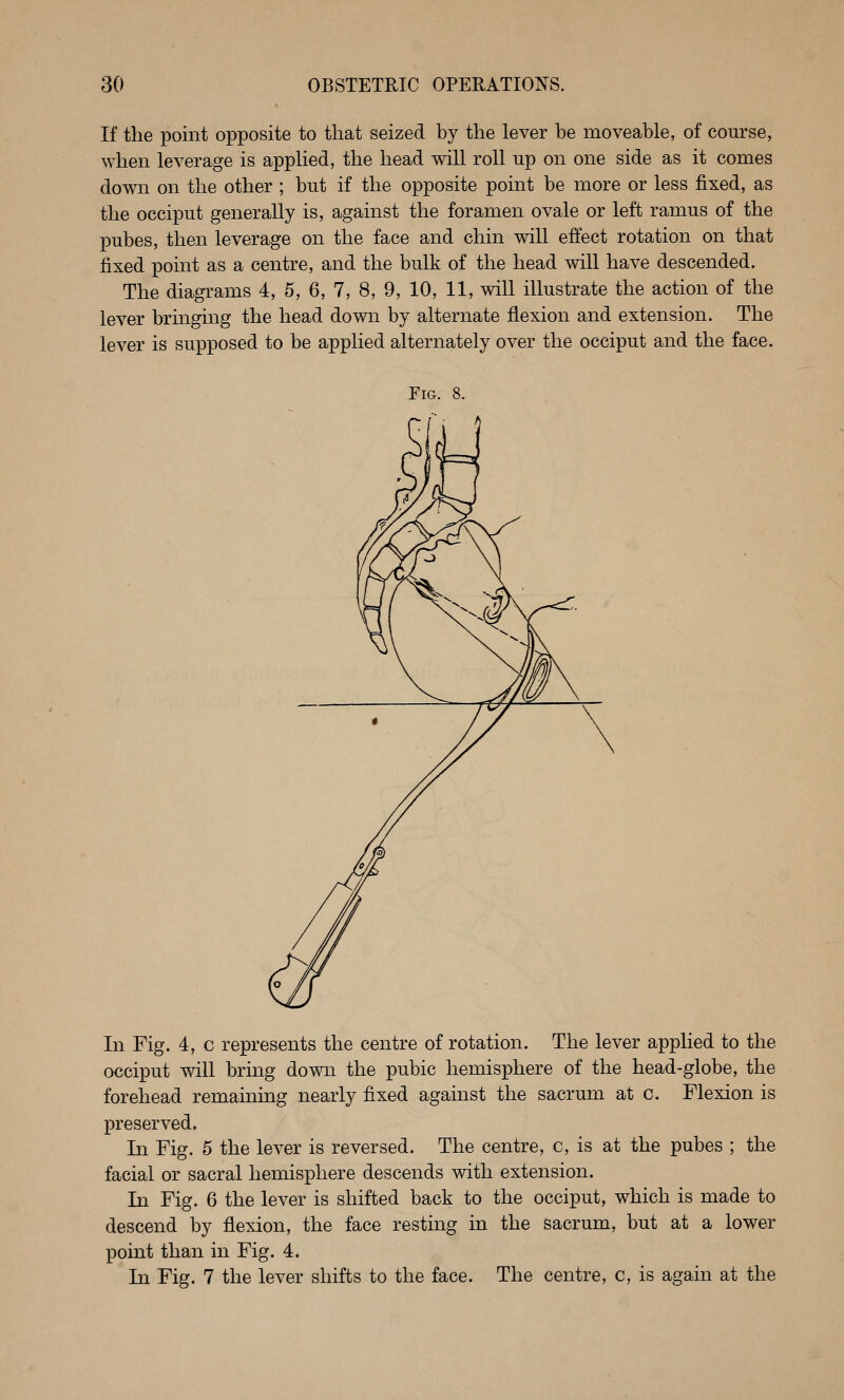 If the point opposite to that seized by the lever be moveable, of course, when leverage is a^Dplied, the head will roll up on one side as it comes down on the other ; but if the opposite point be more or less fixed, as the occiput generally is, against the foramen ovale or left ramus of the pubes, then leverage on the face and chin will effect rotation on that fixed point as a centre, and the bulk of the head will have descended. The diagrams 4, 5, 6, 7, 8, 9, 10, 11, will illustrate the action of the lever brmging the head down by alternate flexion and extension. The lever is supposed to be applied alternately over the occiput and the face. Fig. 8. In Fig. 4, c represents the centre of rotation. The lever applied to the occiput will bring down the pubic hemisphere of the head-globe, the forehead remaining nearly fixed against the sacrum at c. Flexion is preserved. In Fig. 5 the lever is reversed. The centre, c, is at the pubes ; the facial or sacral hemisphere descends with extension. In Fig. 6 the lever is shifted back to the occiput, which is made to descend by flexion, the face resting in the sacrum, but at a lower point than in Fig. 4. In Fig. 7 the lever shifts to the face. The centre, c, is again at the