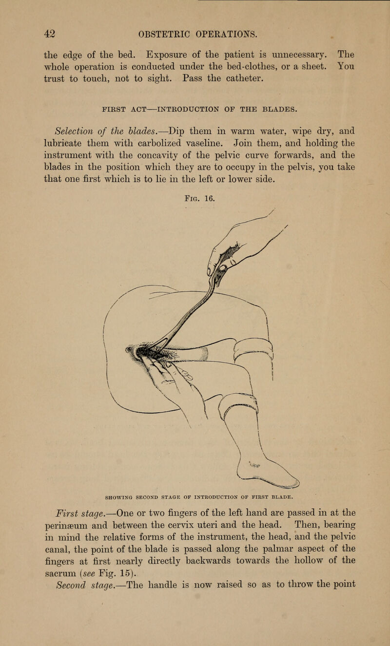 the edge of the bed. Exposure of the patient is unnecessary. The whole operation is conducted under the bed-clothes, or a sheet. You trust to touch, not to sight. Pass the catheter. FIEST ACT INTEODUCTION OP THE BLADES. Selection of the blades.—^Dip them in warm water, wipe dry, and lubricate them with carbolized vaseline. Join them, and holding the instrument with the concavity of the pelvic curve forwards, and the blades in the position which they are to occupy in the pelvis, you take that one first which is to lie in the left or lower side. Fig. 16. SHOWING SECOND STAGE OF INTRODUCTION OF FIEST BLADE. First stage.—One or two fingers of the left hand are passed in at the perinaeum and between the cervix uteri and the head. Then, bearing in mind the relative forms of the instrument, the head, and the pelvic canal, the point of the blade is passed along the palmar aspect of the fingers at first nearly directly backwards towards the hollow of the sacrum (see Fig. 15). Second stage.—The handle is now raised so as to throw the point