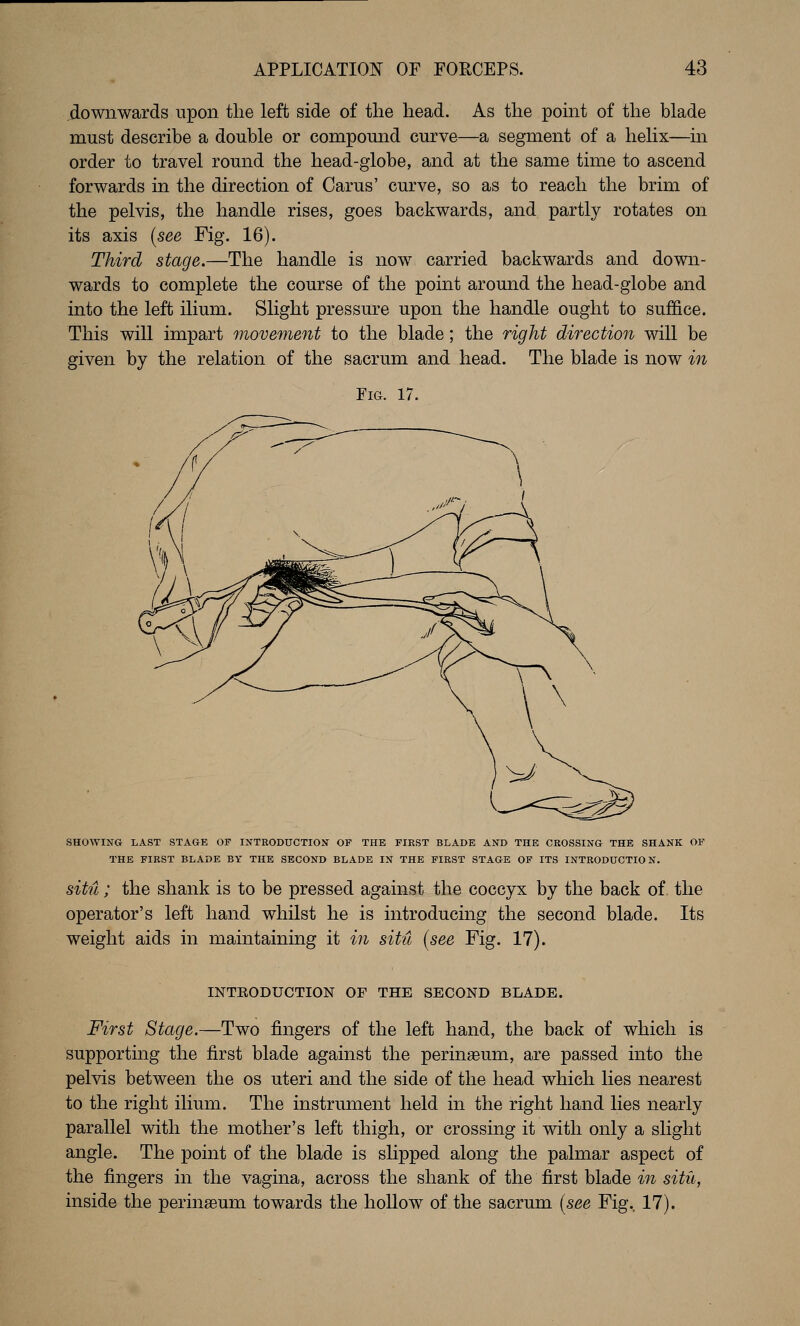 jdownwards upon the left side of the head. As the point of the blade must describe a double or compound curve—a segment of a helix—in order to travel round the head-globe, and at the same time to ascend forwards in the direction of Carus' curve, so as to reach the brim of the pelvis, the handle rises, goes backwards, and partly rotates on its axis {see Fig. 16). Third stage,—The handle is now carried backwards and down- wards to complete the course of the point around the head-globe and into the left ilium. Slight pressure upon the handle ought to suffice. This will impart movement to the blade; the right direction will be given by the relation of the sacrum and head. The blade is now in Fig. 17. SHOWING LAST STAGE OF INTRODUCTION OF THE FIRST BLADE AND THE CROSSING THE SHANK OF THE FIRST BLADE BY THE SECOND BLADE IN THE FIRST STAGE OF ITS INTRODUCTION. sitil; the shank is to be pressed against the coccyx by the back of. the operator's left hand whilst he is introducing the second blade. Its weight aids in maintaining it m situ (see Fig. 17). INTEODUCTION OF THE SECOND BLADE. First Stage.—Two fingers of the left hand, the back of which is supporting the first blade against the perinaeum, are passed into the pelvis between the os uteri and the side of the head which lies nearest to the right ilium. The instrument held in the right hand lies nearly parallel with the mother's left thigh, or crossing it with only a slight angle. The point of the blade is sKpped along the palmar aspect of the fingers in the vagina, across the shank of the first blade in situ, inside the perinaeum towards the hoUow of the sacrum [see Fig. 17).