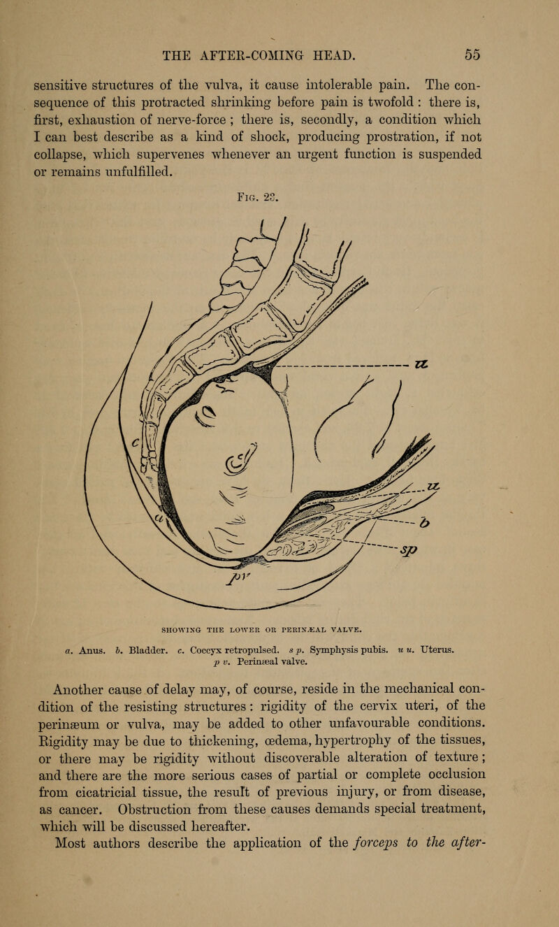 sensitive structures of tlie vulva, it cause intolerable pain. The con- sequence of this protracted shrinking before pain is twofold : there is, first, exhaustion of nerve-force ; there is, secondly, a condition which I can best describe as a kind of shock, producing prostration, if not collapse, which supervenes whenever an urgent function is suspended or remains unfulfilled. Fig. 23. SHOWIXG THE LOWKR OR PEKIXJiAL VALVE. a. Anus. h. Bladder, c. Coccyx retropulsed. s p. Symphysis pubis, u u. Uterus. p V. Perinseal valve. Another cause of delay may, of course, reside in the mechanical con- dition of the resisting structures: rigidity of the cervix uteri, of the perinaeum or vulva, may be added to other unfavourable conditions. Eigidity may be due to thickening, oedema, hypertrophy of the tissues, or there may be rigidity without discoverable alteration of texture; and there are the more serious cases of partial or complete occlusion from cicatricial tissue, the result of previous injury, or from disease, as cancer. Obstruction from these causes demands special treatment, which will be discussed hereafter. Most authors describe the application of the forceps to the after-
