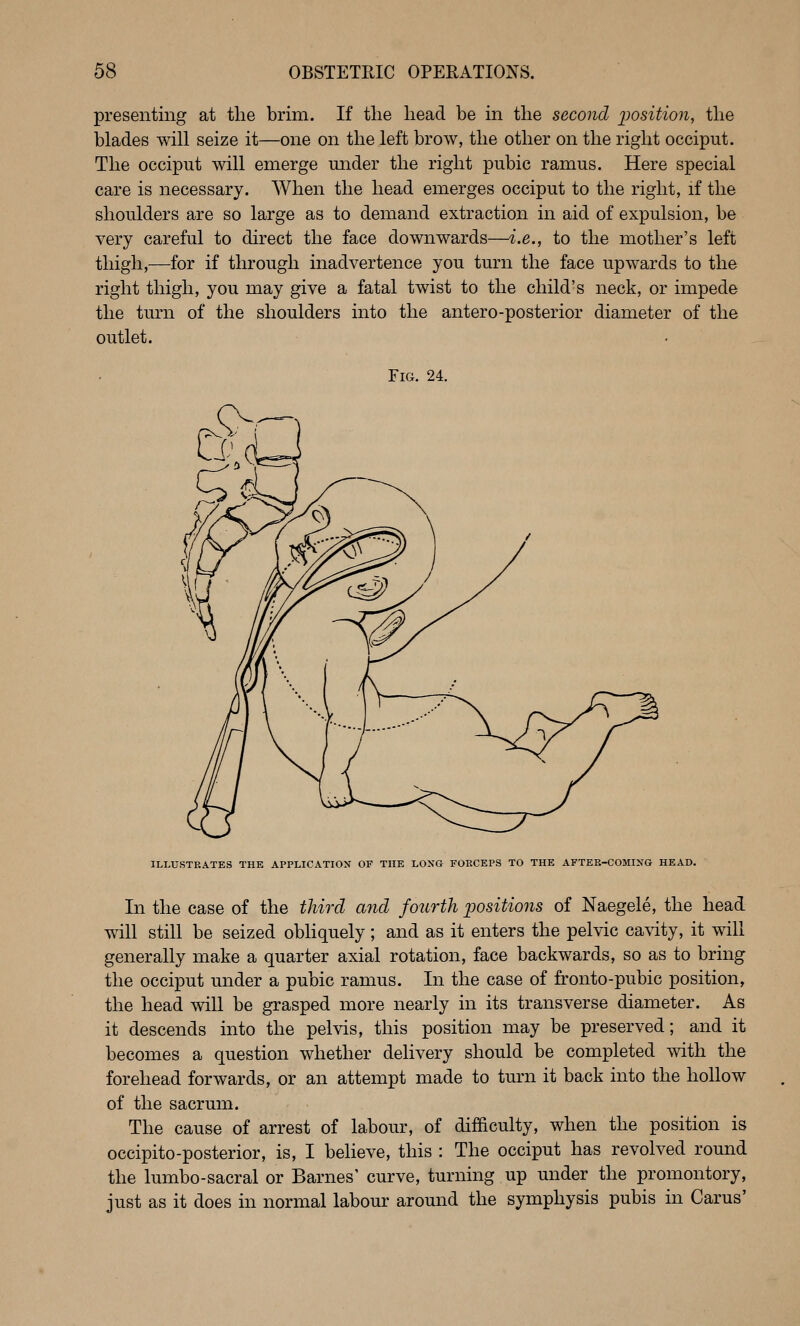 presenting at the brim. If tlie head be in the second jjosition, the blades will seize it—one on the left brow, the other on the right occiput. The occiput will emerge mider the right pubic ramus. Here special care is necessary. When the head emerges occiput to the right, if the shoulders are so large as to demand extraction in aid of expulsion, be very careful to direct the face downwards—i.e., to the mother's left thigh,—for if through inadvertence you turn the face upwards to the right thigh, you may give a fatal twist to the child's neck, or impede the turn of the shoulders into the antero-posterior diameter of the outlet. Fig. 24. ILLUSTRATES THE APPLIGATIOX OF THE LONG FOECEPS TO THE AFTEE-COMIXG HEAD. In the case of the third and fotirth positions of Naegele, the head wdll still be seized obliquely; and as it enters the pelvic cavity, it will generally make a quarter axial rotation, face backwards, so as to bring the occiput under a pubic ramus. In the case of fronto-pubic position, the head will be grasped more nearly in its transverse diameter. As it descends into the pelvis, this position may be preserved; and it becomes a question whether delivery should be completed with the forehead forwards, or an attempt made to turn it back into the hollow of the sacrum. The cause of arrest of labour, of difficulty, when the position is occipito-posterior, is, I beheve, this : The occiput has revolved round the lumbo-sacral or Barnes' curve, turning up under the promontory, just as it does in normal labour around the symphysis pubis in Carus'